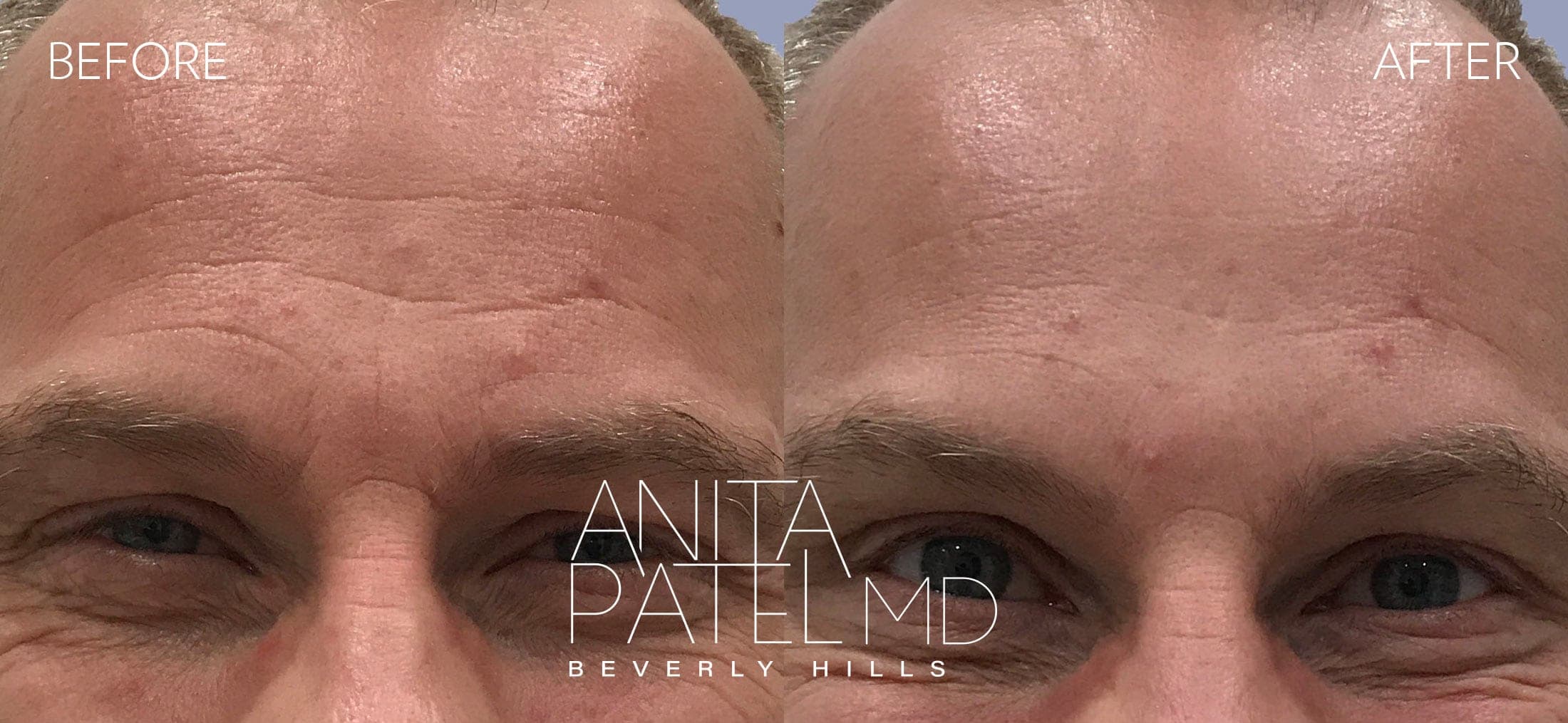 Neurotoxin before and after — Patient 7, photo 1 of 3 — Dr. Anita Patel, MD, FACS, Beverly Hills