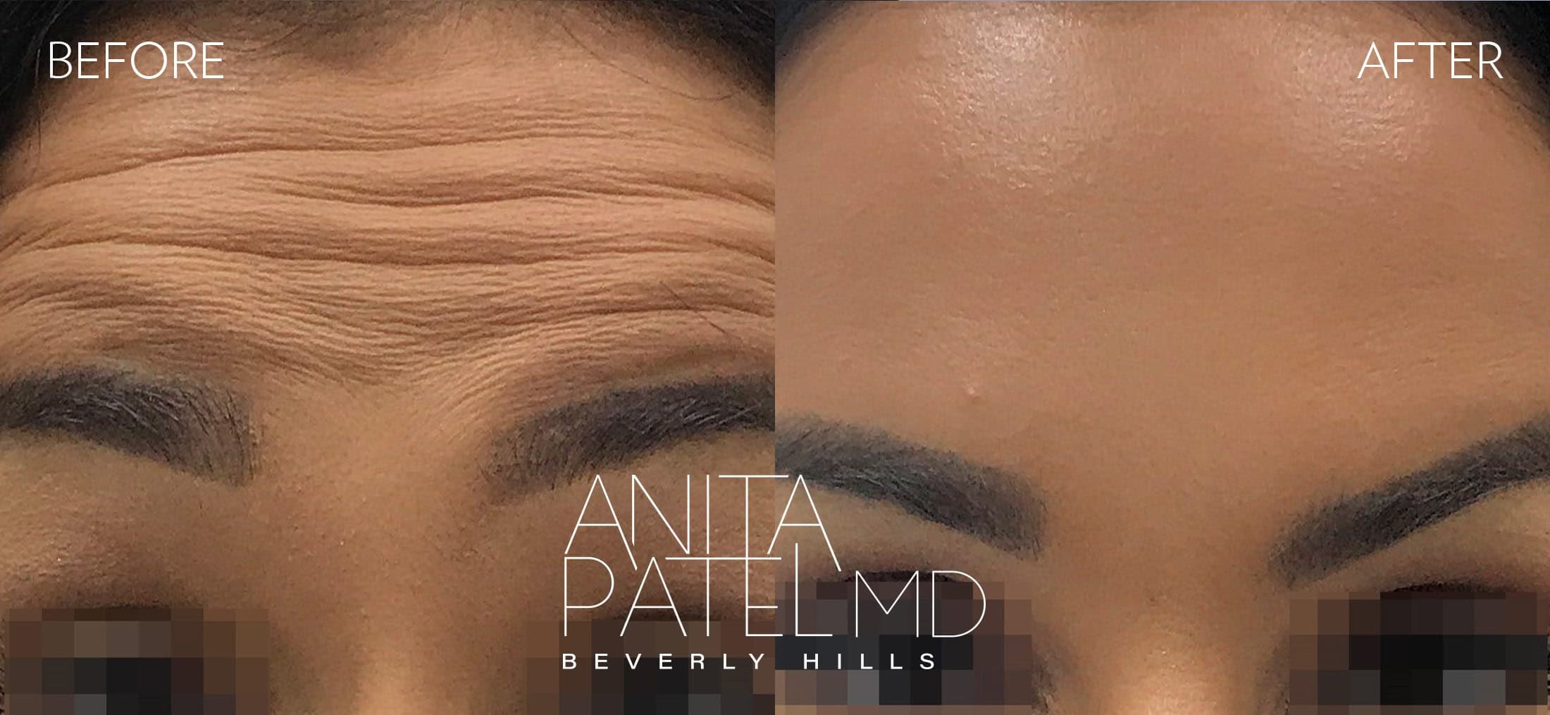 Neurotoxin before and after — Patient 1, photo 2 of 2 — Dr. Anita Patel, MD, FACS, Beverly Hills