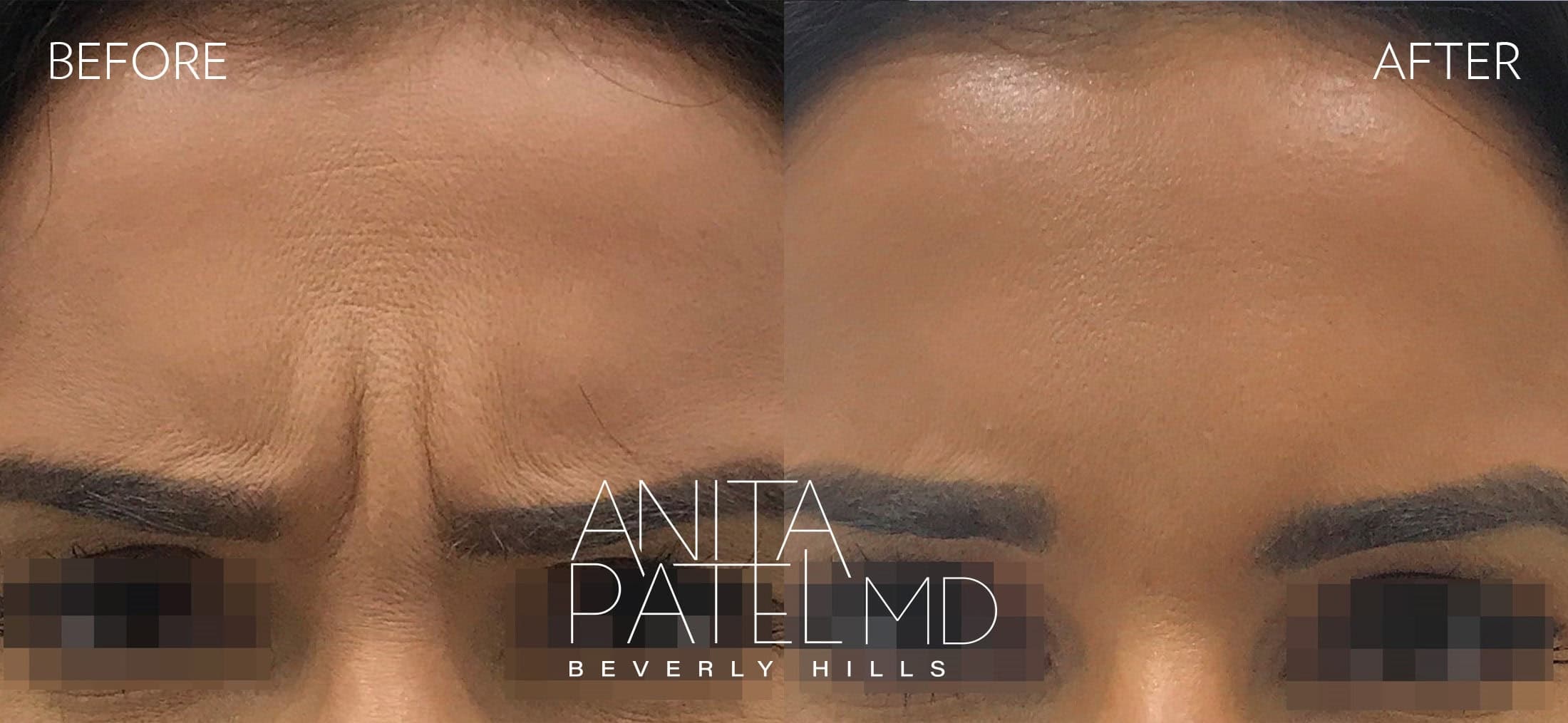 Neurotoxin before and after — Patient 1, photo 1 of 2 — Dr. Anita Patel, MD, FACS, Beverly Hills