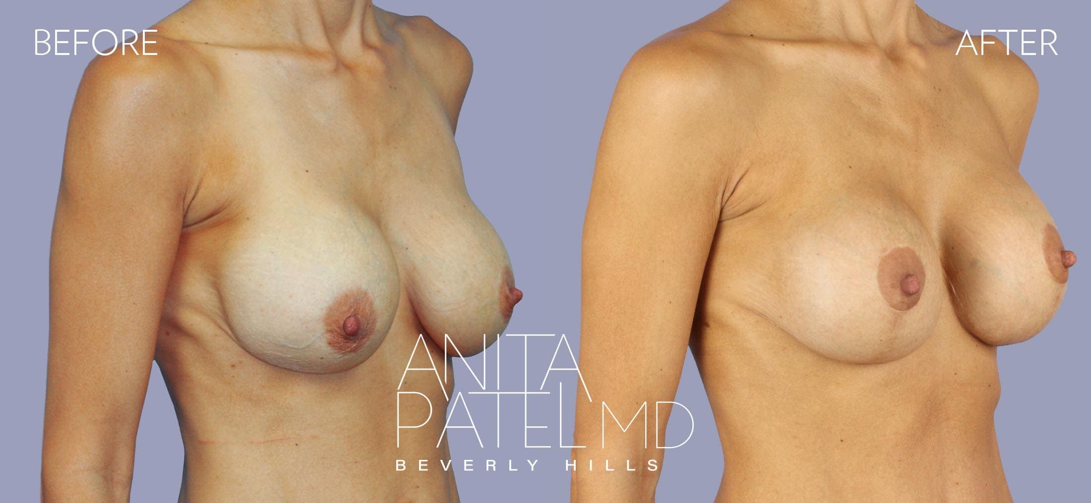 Breast Implant Replacement before and after — Patient 5, photo 1 of 3 — Dr. Anita Patel, MD, FACS, Beverly Hills
