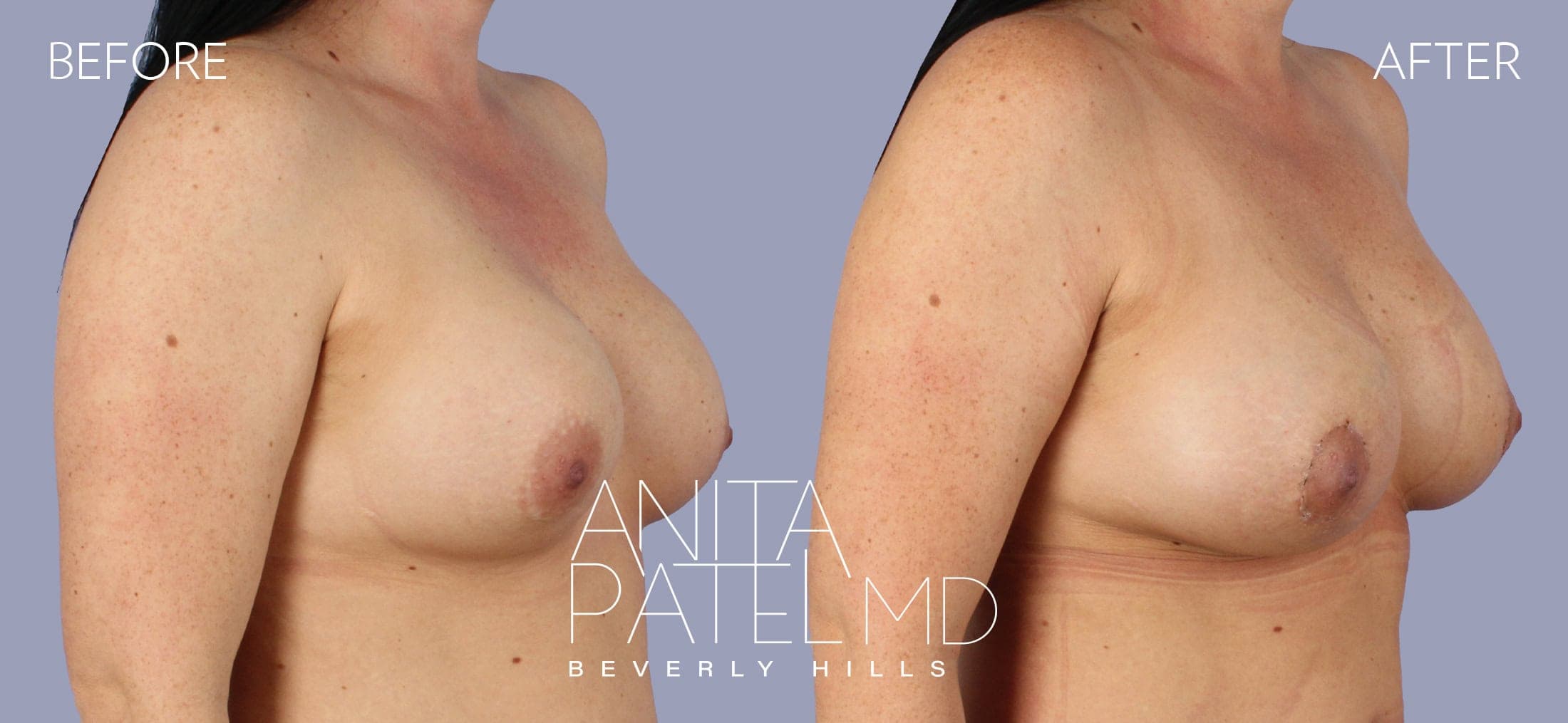 Breast Lift before and after — Patient 2, photo 2 of 5 — Dr. Anita Patel, MD, FACS, Beverly Hills