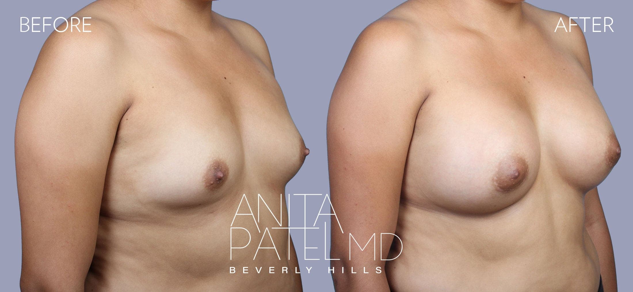 Breast Augmentation before and after — Patient 18, photo 2 of 5 — Dr. Anita Patel, MD, FACS, Beverly Hills
