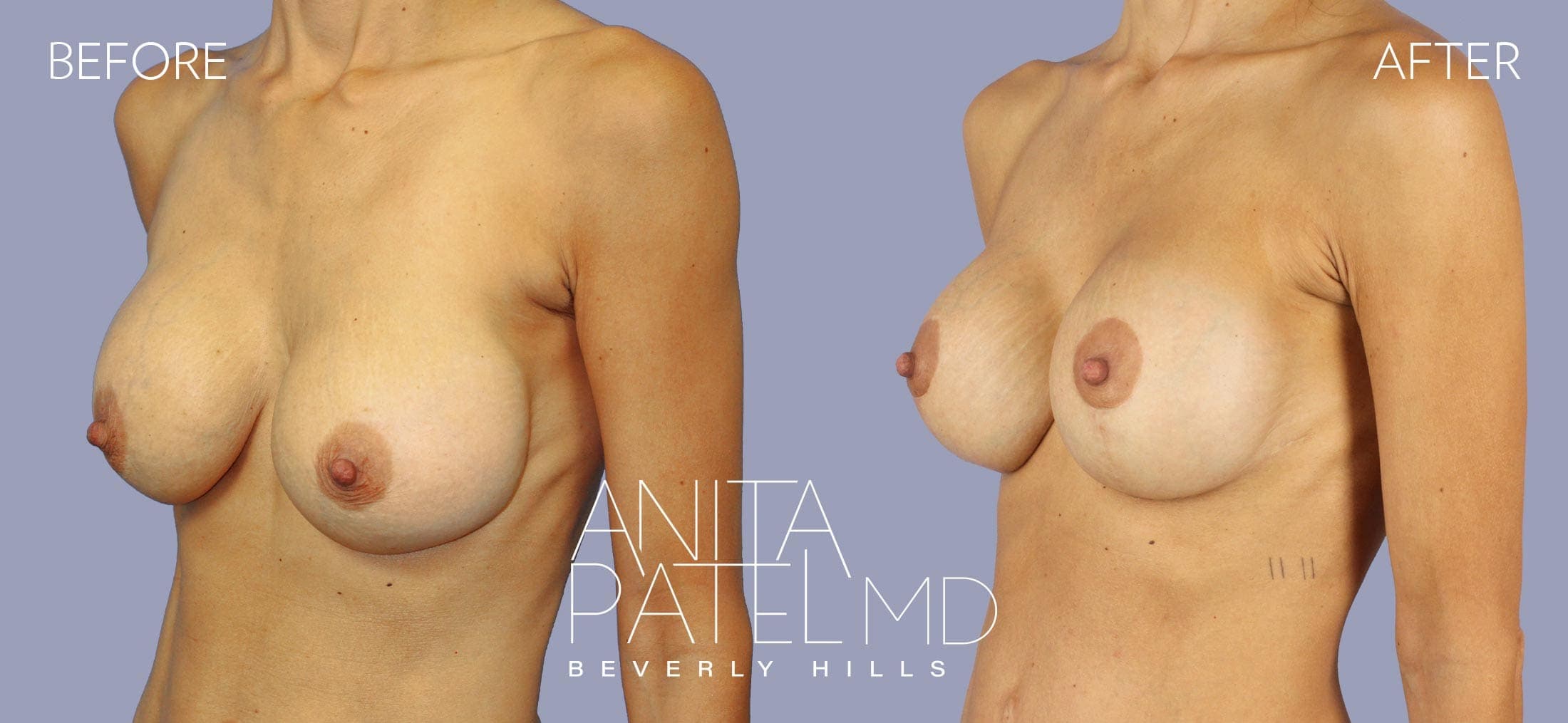 Breast Implant Replacement before and after — Patient 5, photo 3 of 3 — Dr. Anita Patel, MD, FACS, Beverly Hills