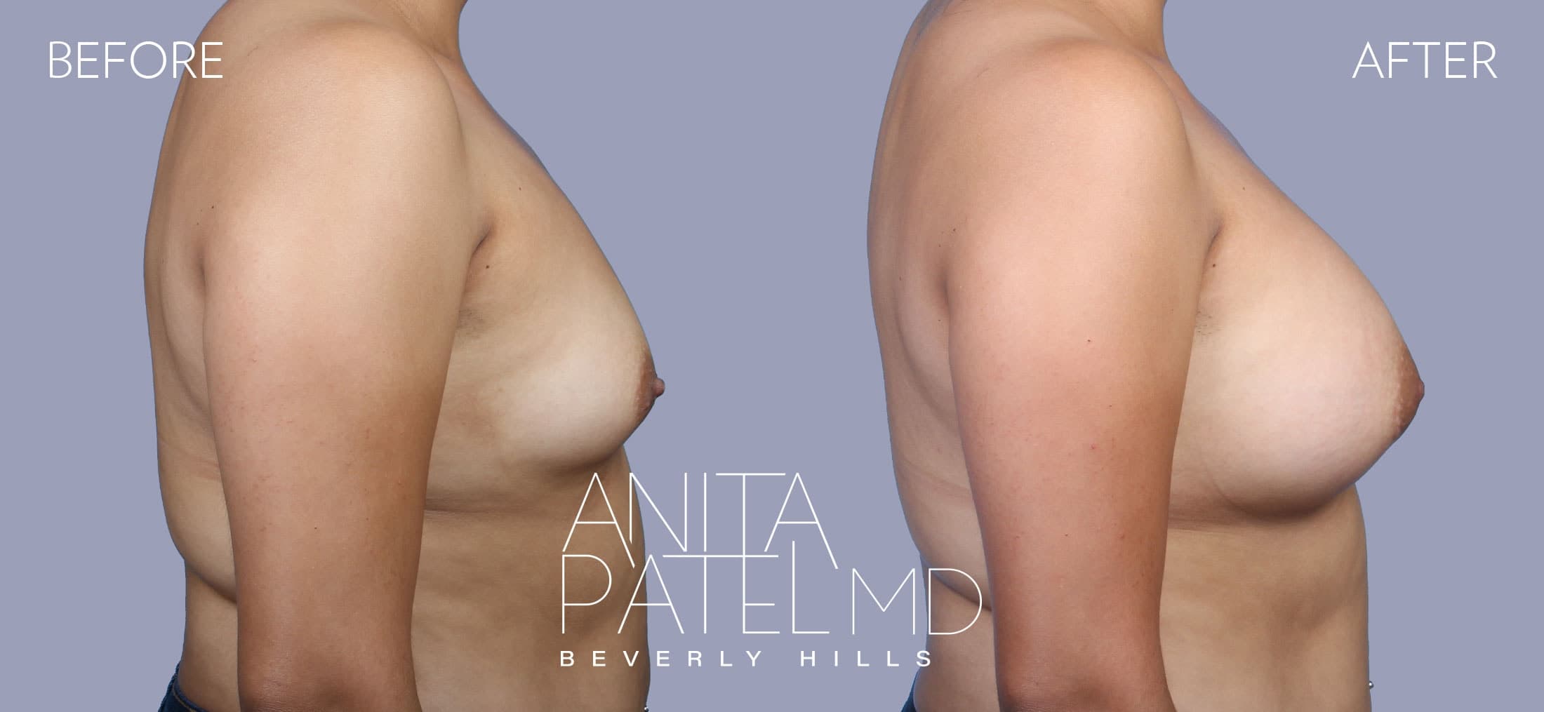 Breast Augmentation before and after — Patient 18, photo 3 of 5 — Dr. Anita Patel, MD, FACS, Beverly Hills