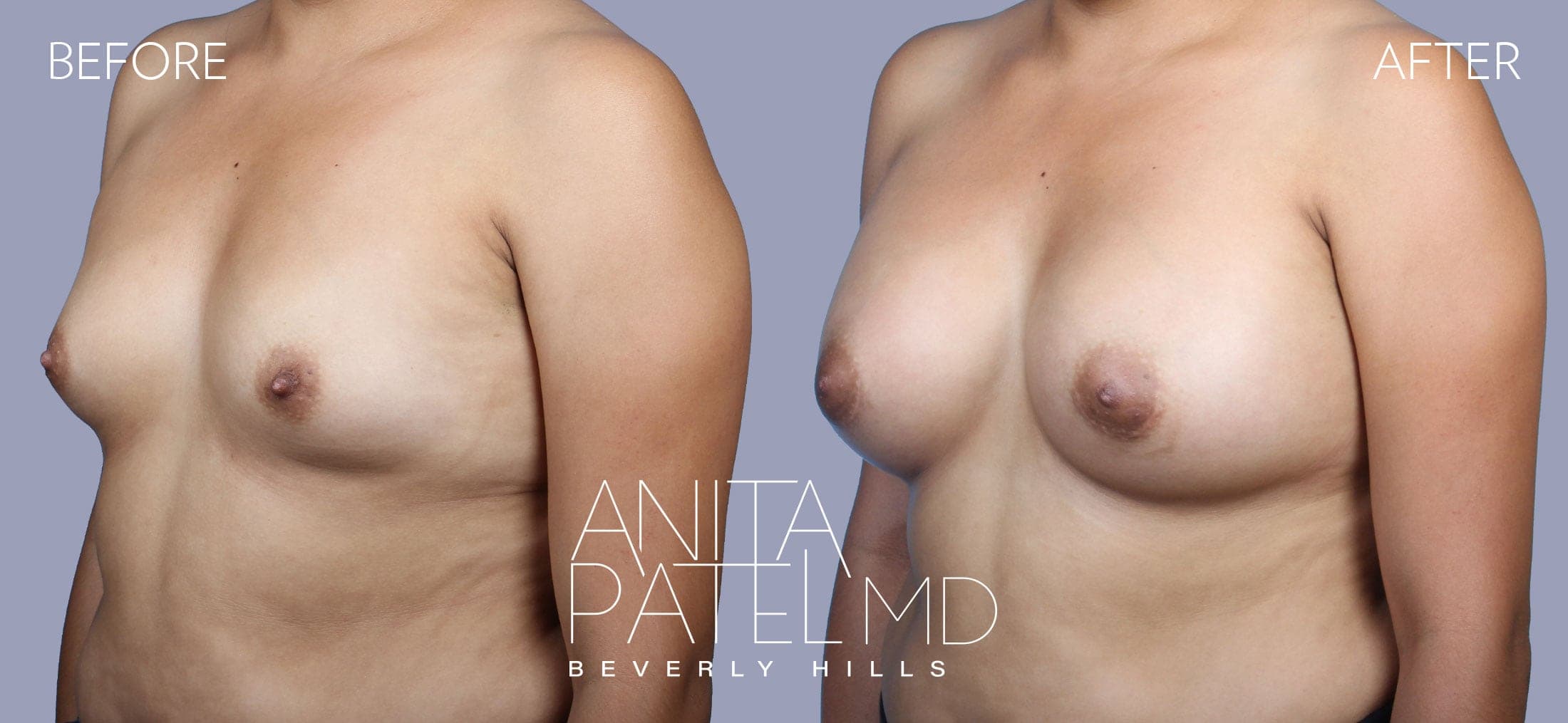 Breast Augmentation before and after — Patient 18, photo 4 of 5 — Dr. Anita Patel, MD, FACS, Beverly Hills