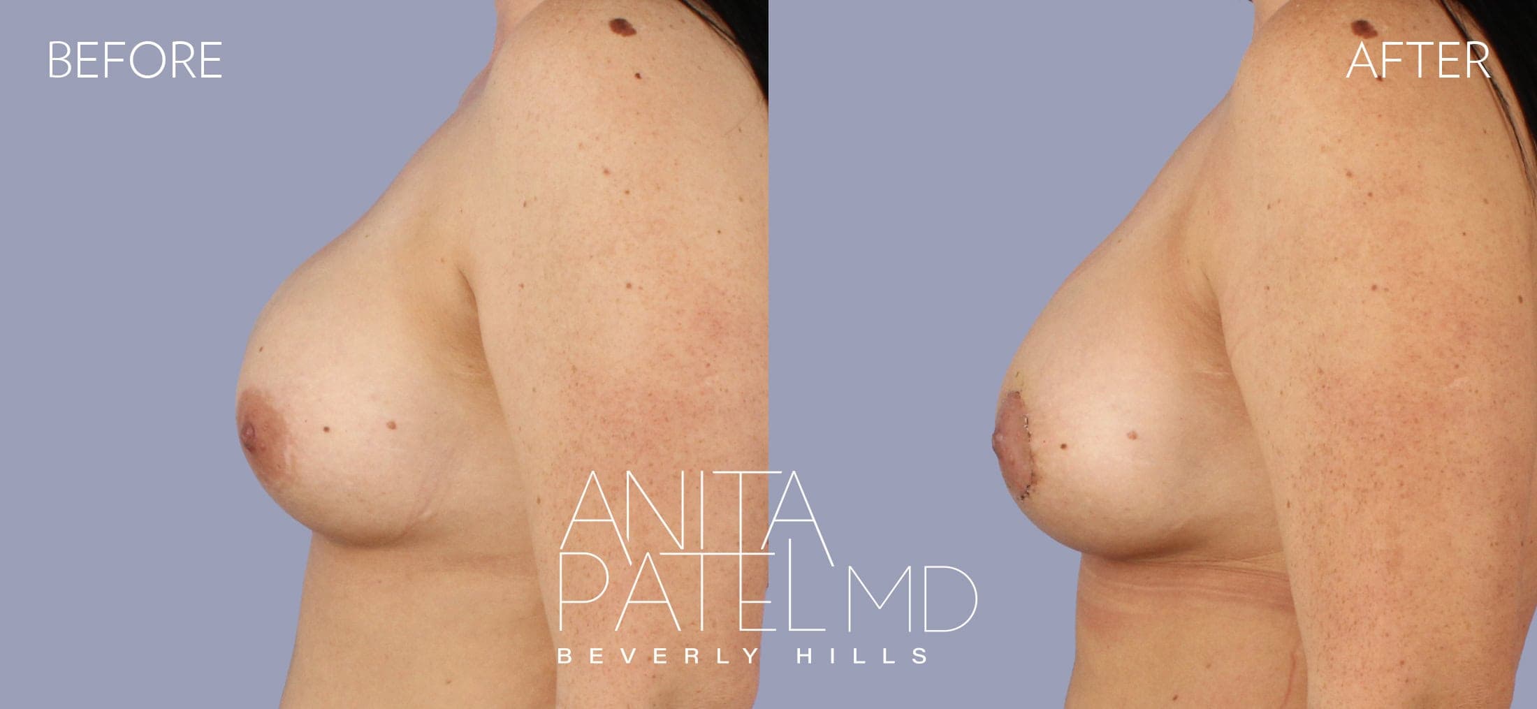 Breast Lift before and after — Patient 2, photo 5 of 5 — Dr. Anita Patel, MD, FACS, Beverly Hills