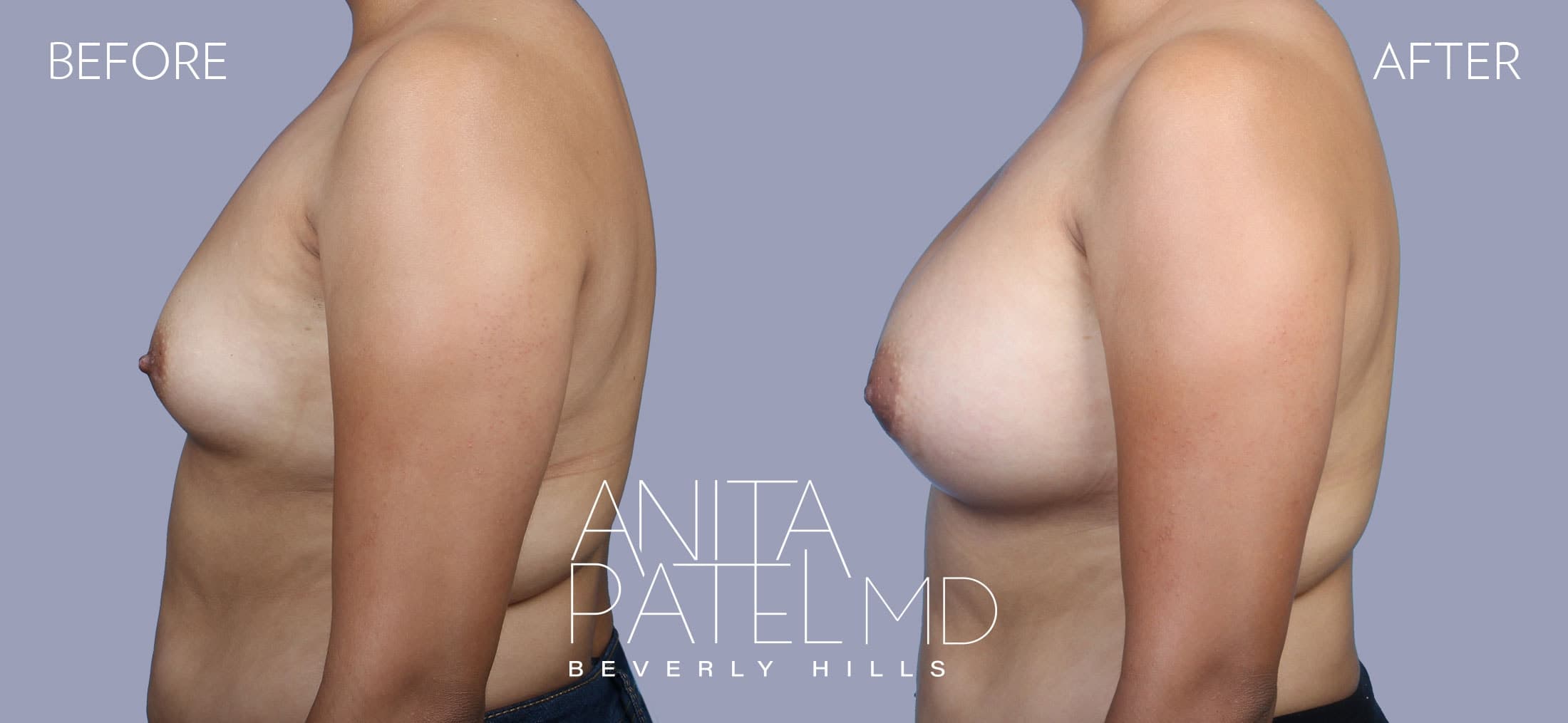 Breast Augmentation before and after — Patient 18, photo 5 of 5 — Dr. Anita Patel, MD, FACS, Beverly Hills
