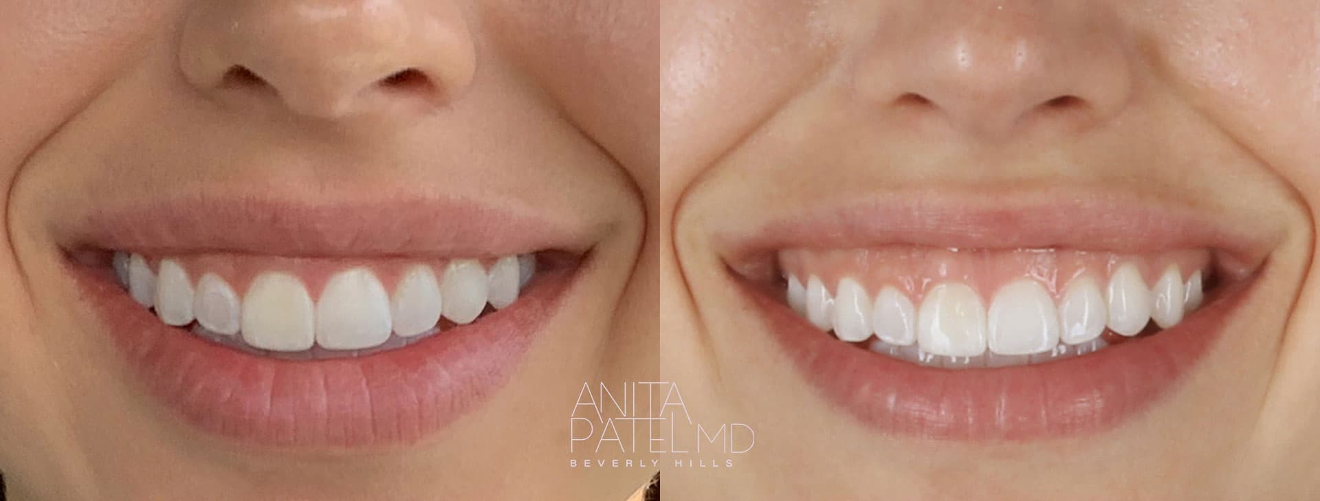 Gummy Smile before and after — Dr. Anita Patel, Beverly Hills
