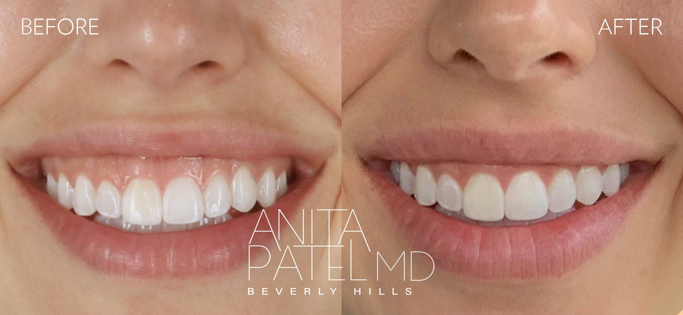 Neurotoxin before and after — Patient 1 — Dr. Anita Patel, MD, FACS, Beverly Hills