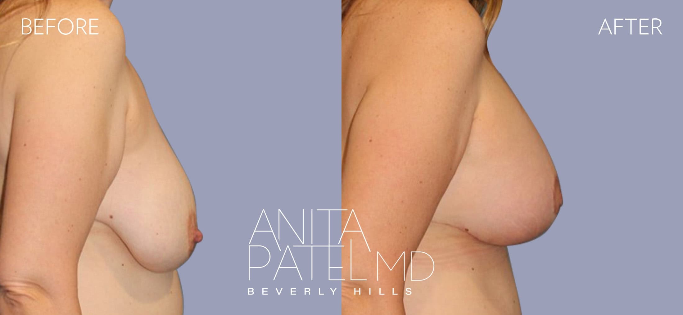 Breast Lift before and after — Patient 17, photo 2 of 4 — Dr. Anita Patel, MD, FACS, Beverly Hills