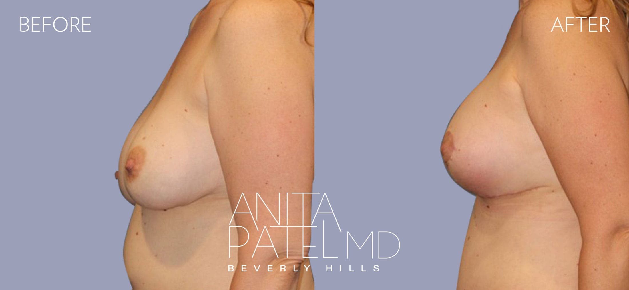 Breast Lift before and after — Patient 17, photo 4 of 4 — Dr. Anita Patel, MD, FACS, Beverly Hills