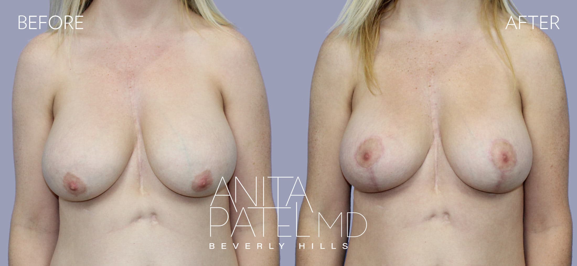 Breast Lift before and after — Patient 16, photo 1 of 3 — Dr. Anita Patel, MD, FACS, Beverly Hills