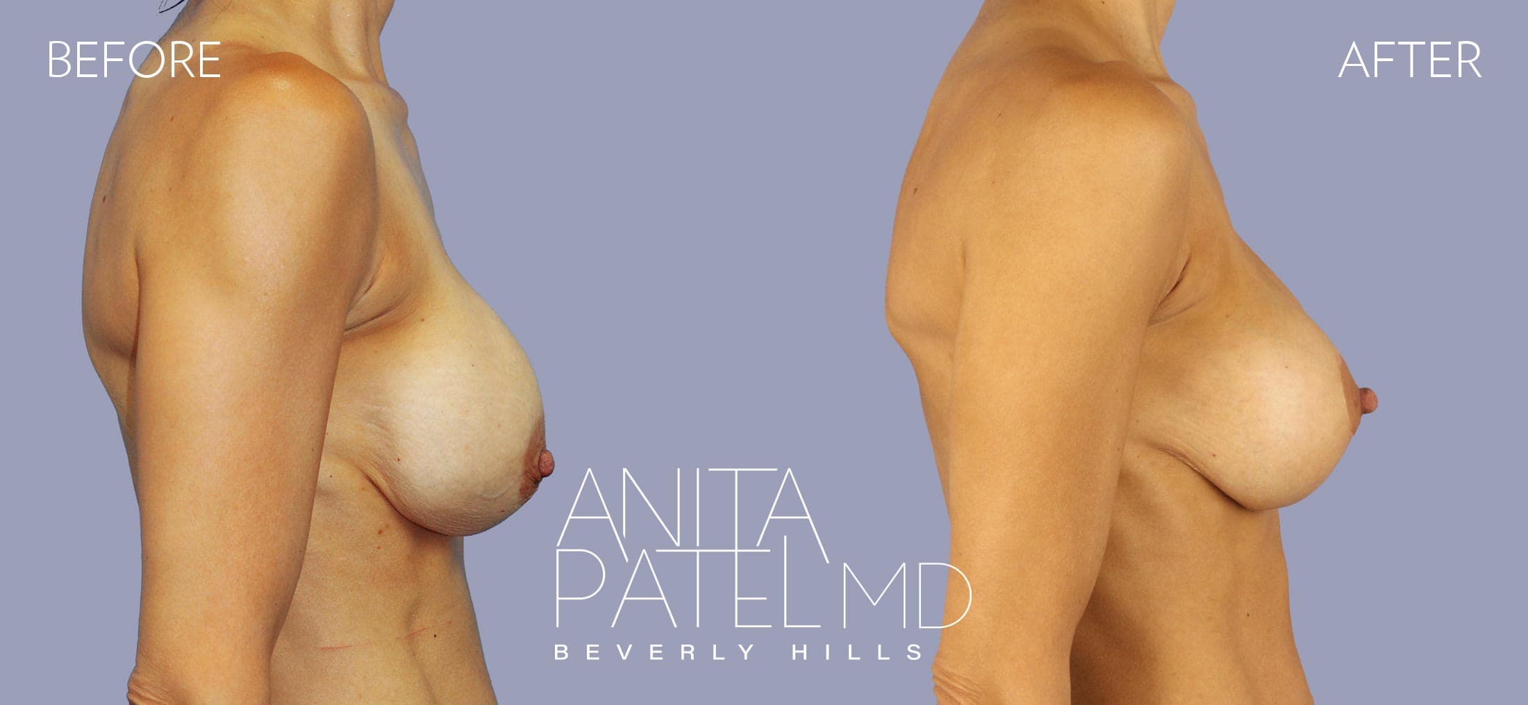 Breast Lift before and after — Patient 15, photo 2 of 3 — Dr. Anita Patel, MD, FACS, Beverly Hills