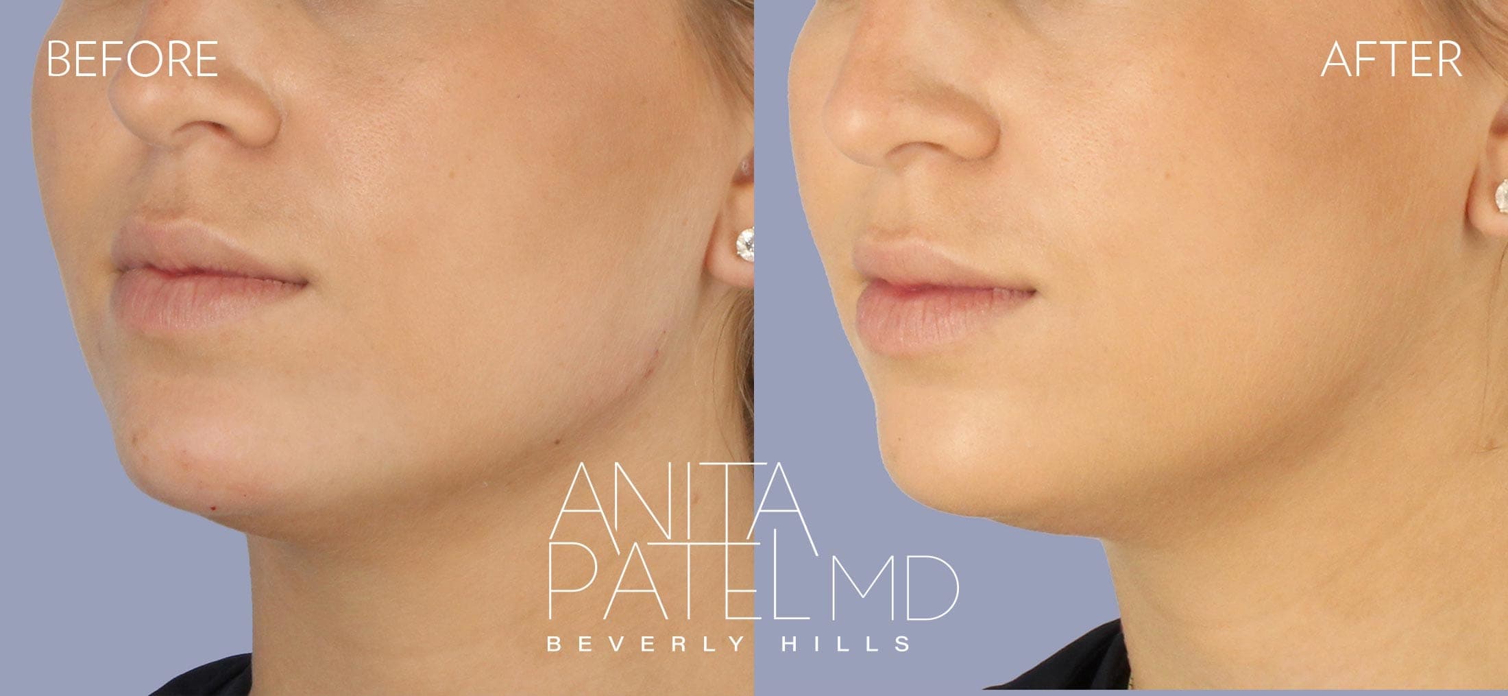 Dermal Fillers before and after — Patient 1 — Dr. Anita Patel, MD, FACS, Beverly Hills