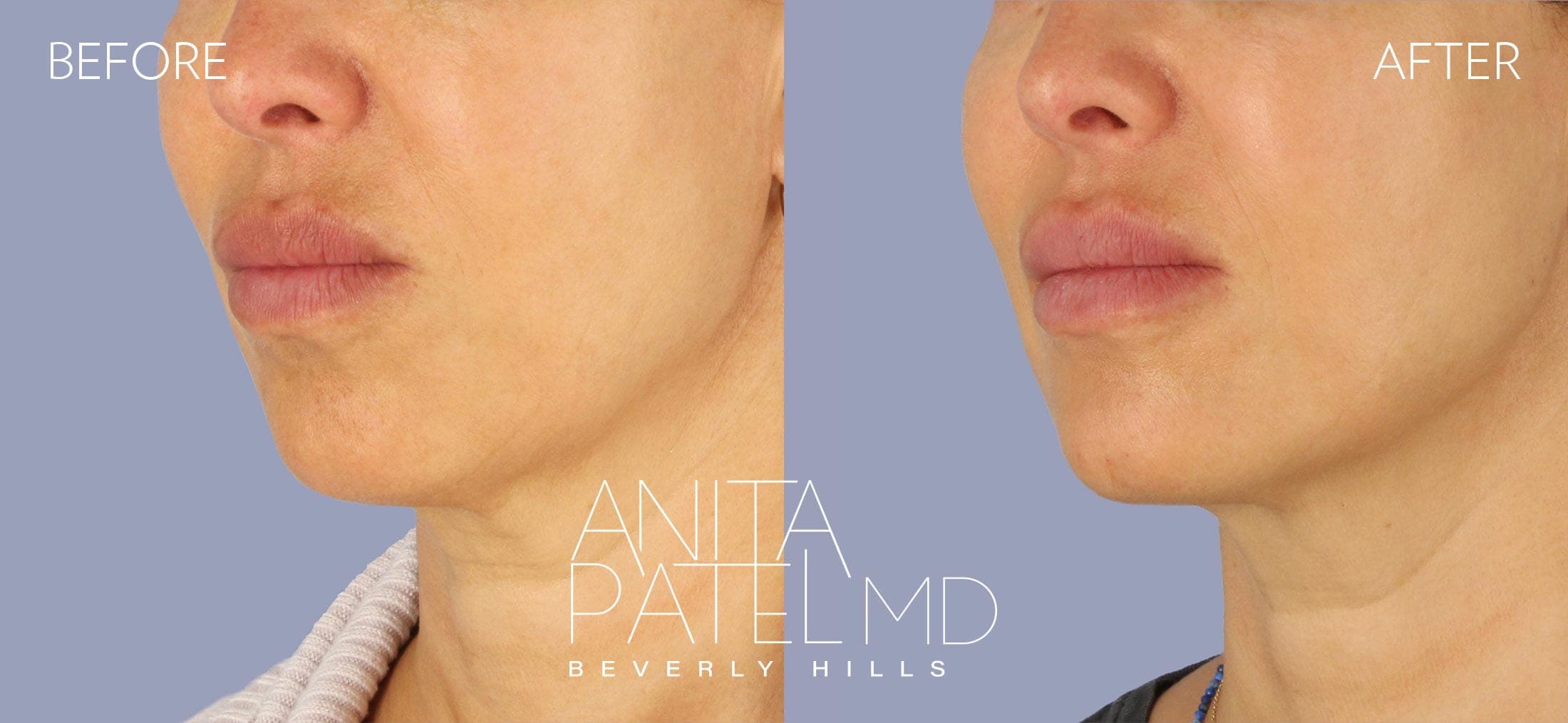 Dermal Fillers before and after — Patient 2, photo 1 of 2 — Dr. Anita Patel, MD, FACS, Beverly Hills