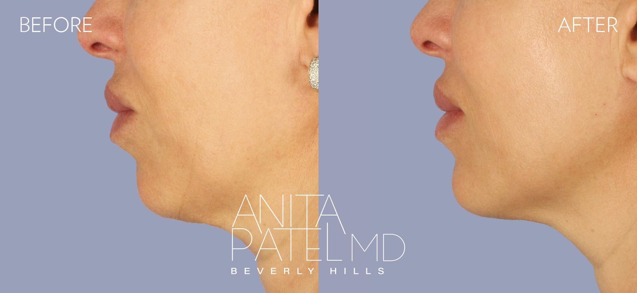 Dermal Fillers before and after — Patient 2, photo 2 of 2 — Dr. Anita Patel, MD, FACS, Beverly Hills