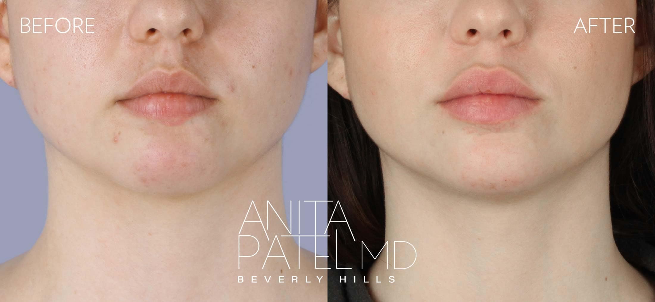 Dermal Fillers before and after — Patient 3, photo 1 of 5 — Dr. Anita Patel, MD, FACS, Beverly Hills