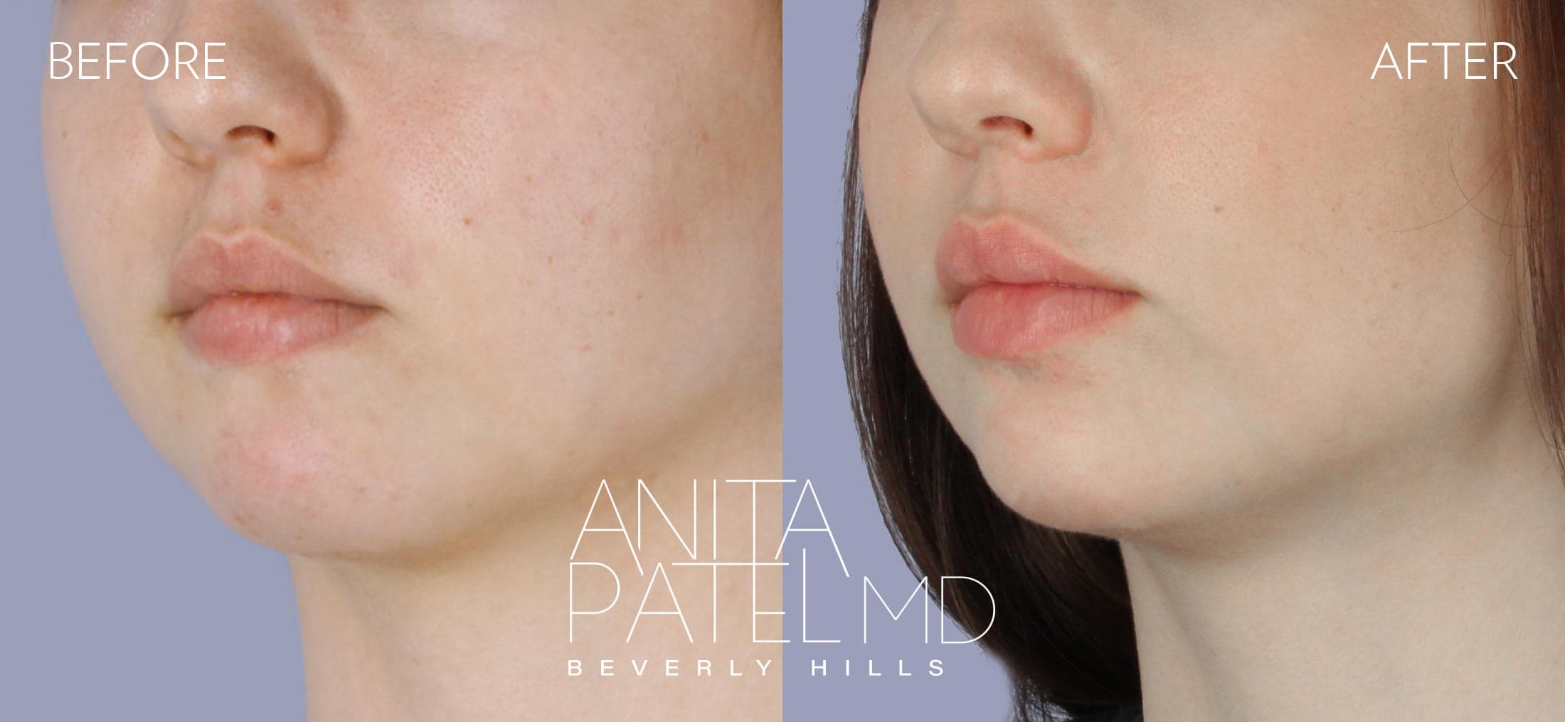 Dermal Fillers before and after — Patient 3, photo 2 of 5 — Dr. Anita Patel, MD, FACS, Beverly Hills