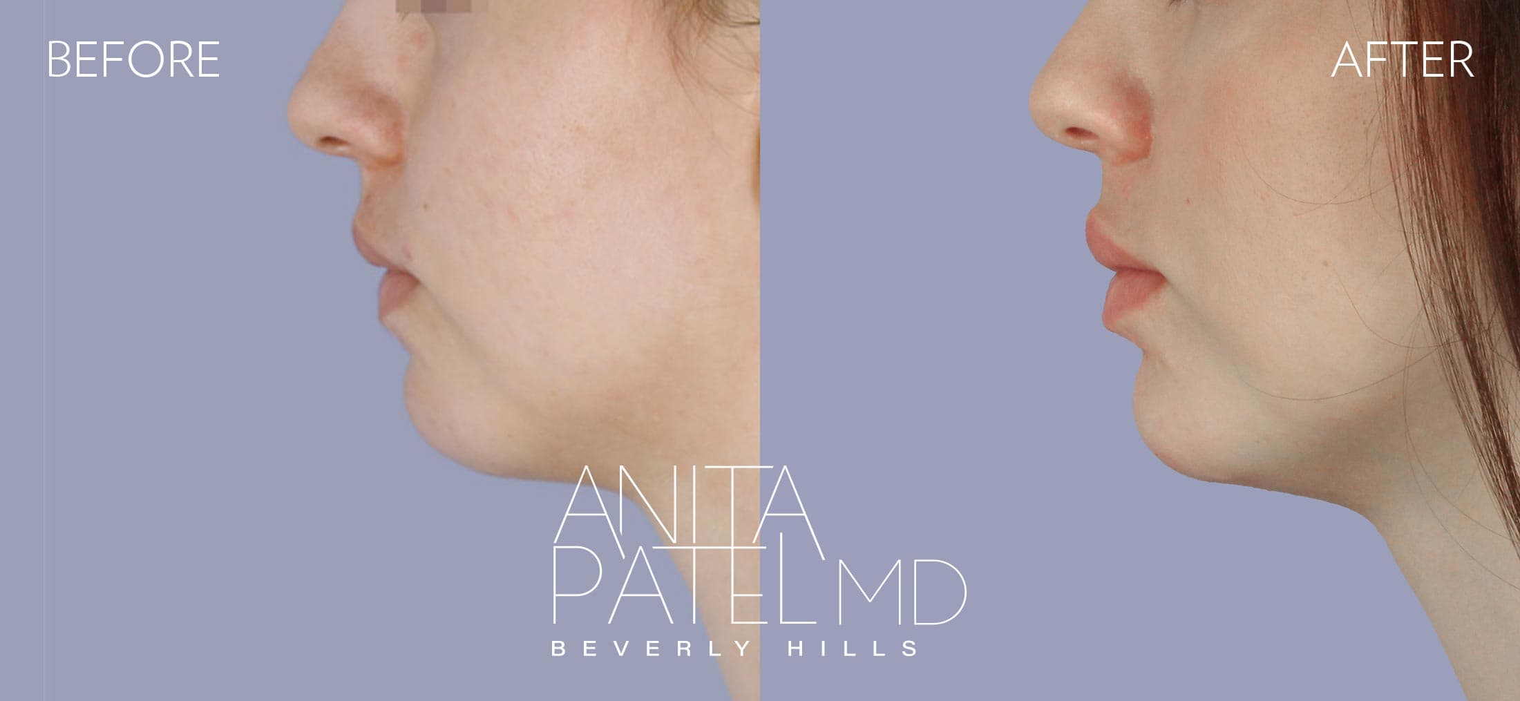 Dermal Fillers before and after — Patient 3, photo 3 of 5 — Dr. Anita Patel, MD, FACS, Beverly Hills