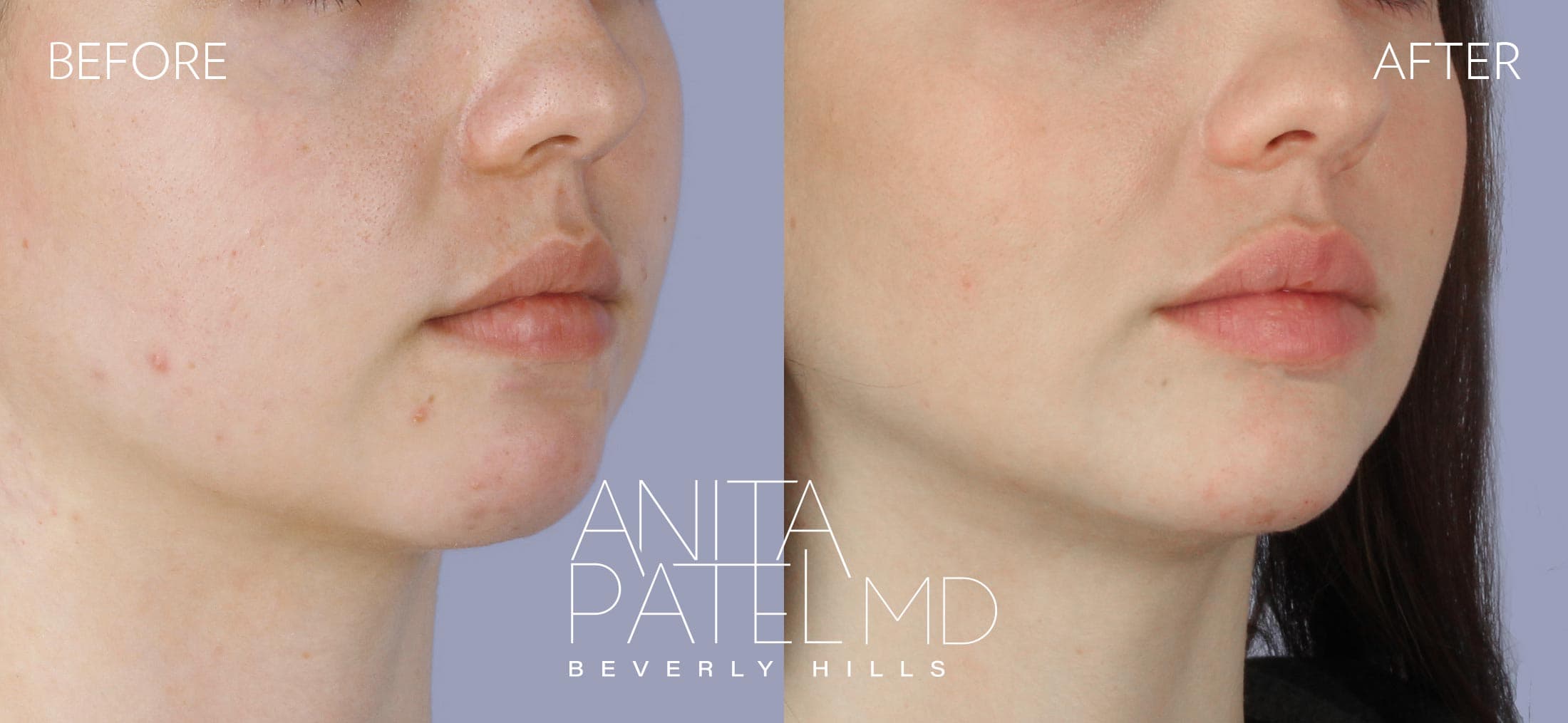Dermal Fillers before and after — Patient 3, photo 4 of 5 — Dr. Anita Patel, MD, FACS, Beverly Hills