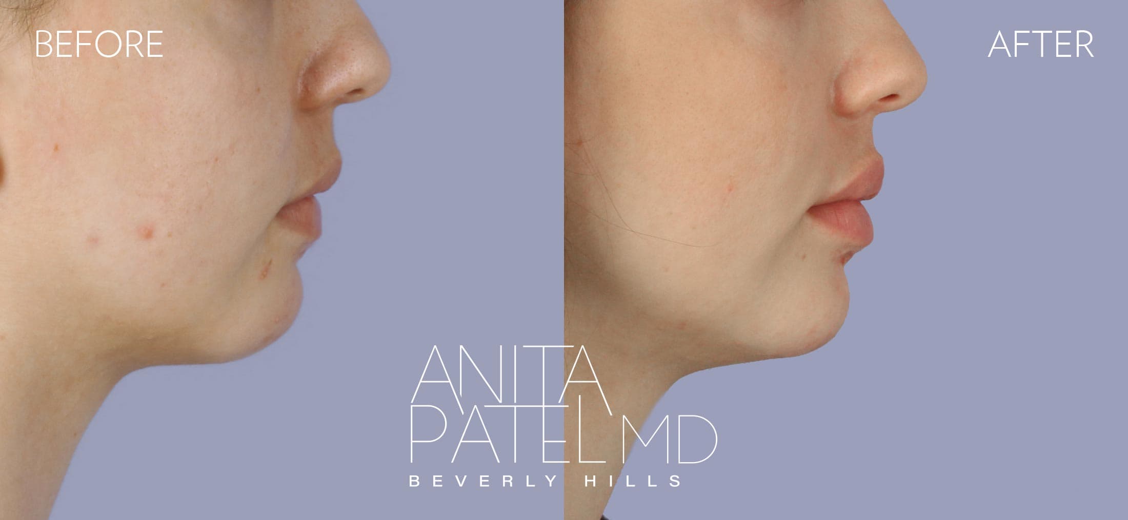 Dermal Fillers before and after — Patient 3, photo 5 of 5 — Dr. Anita Patel, MD, FACS, Beverly Hills