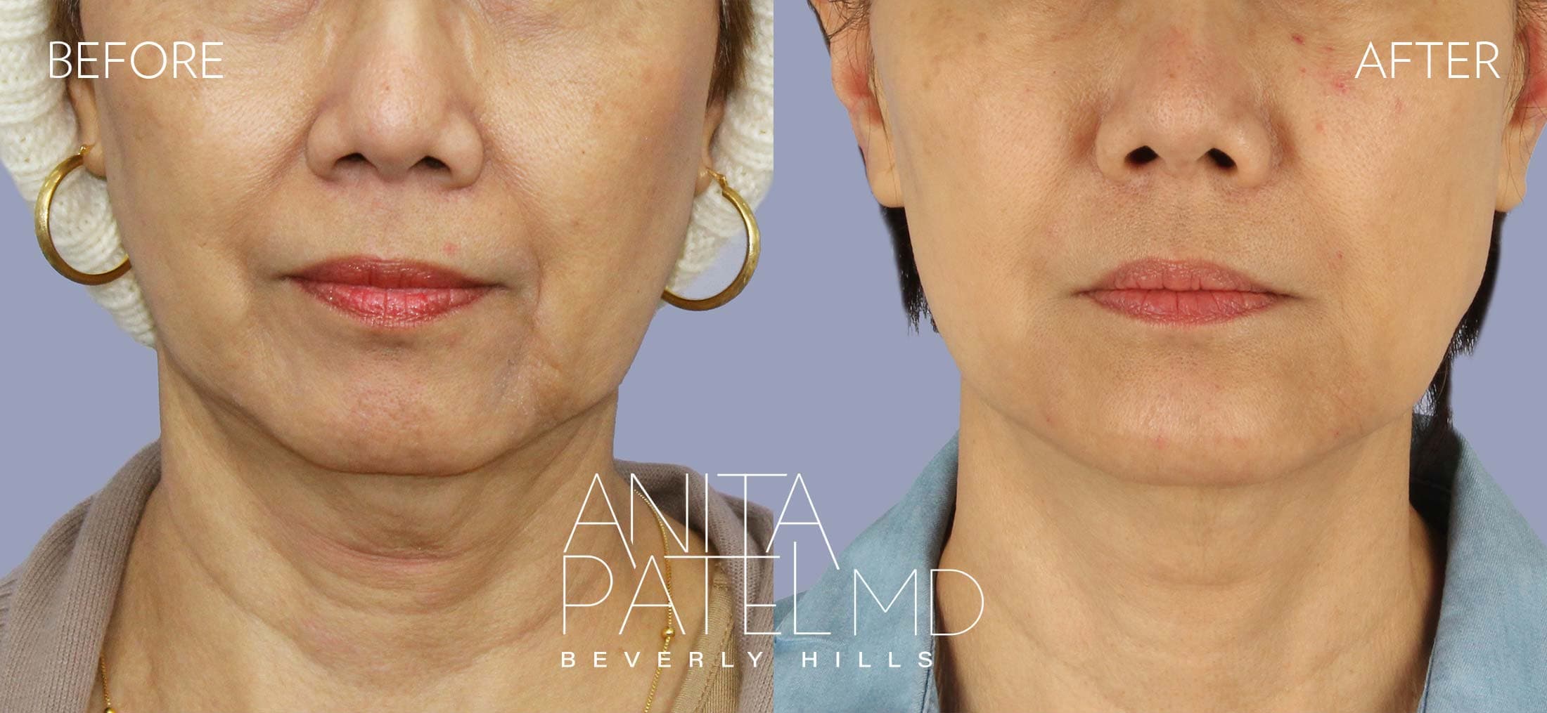 Dermal Fillers before and after — Patient 5, photo 1 of 3 — Dr. Anita Patel, MD, FACS, Beverly Hills