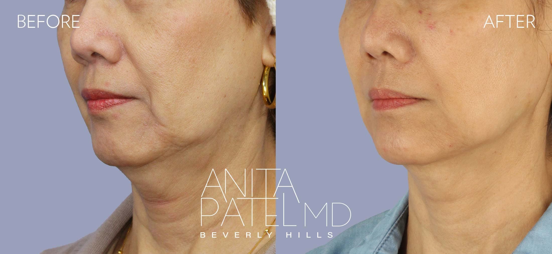 Dermal Fillers before and after — Patient 5, photo 2 of 3 — Dr. Anita Patel, MD, FACS, Beverly Hills