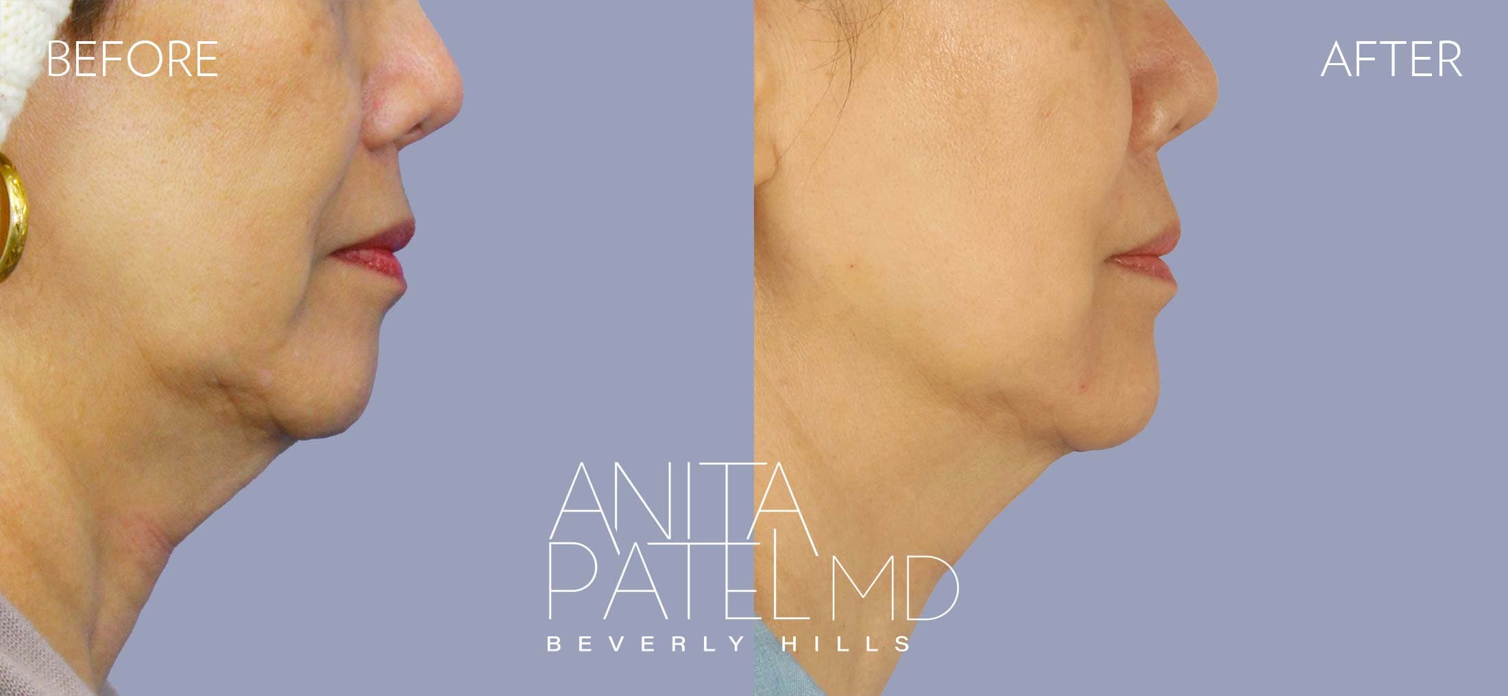 Dermal Fillers before and after — Patient 5, photo 3 of 3 — Dr. Anita Patel, MD, FACS, Beverly Hills