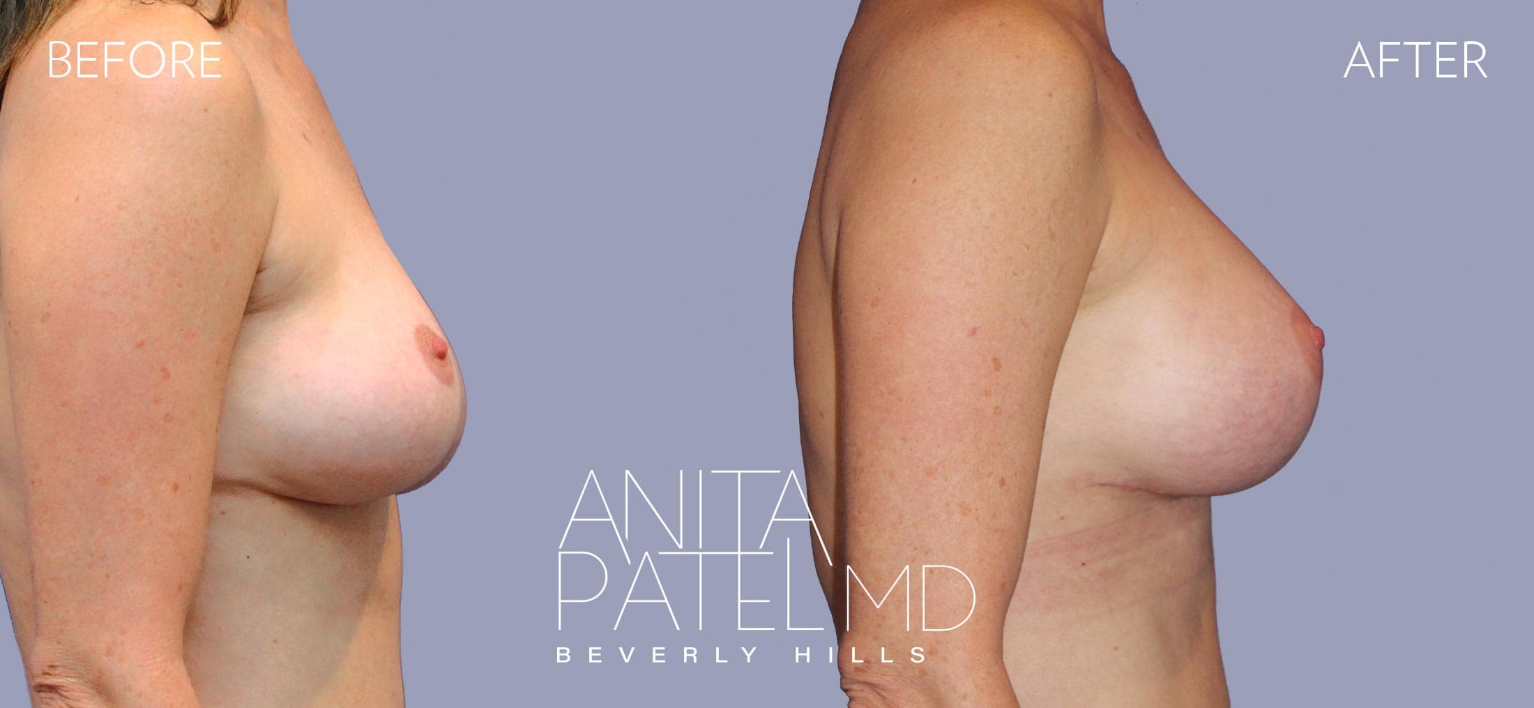 Breast Lift before and after — Patient 14, photo 3 of 3 — Dr. Anita Patel, MD, FACS, Beverly Hills