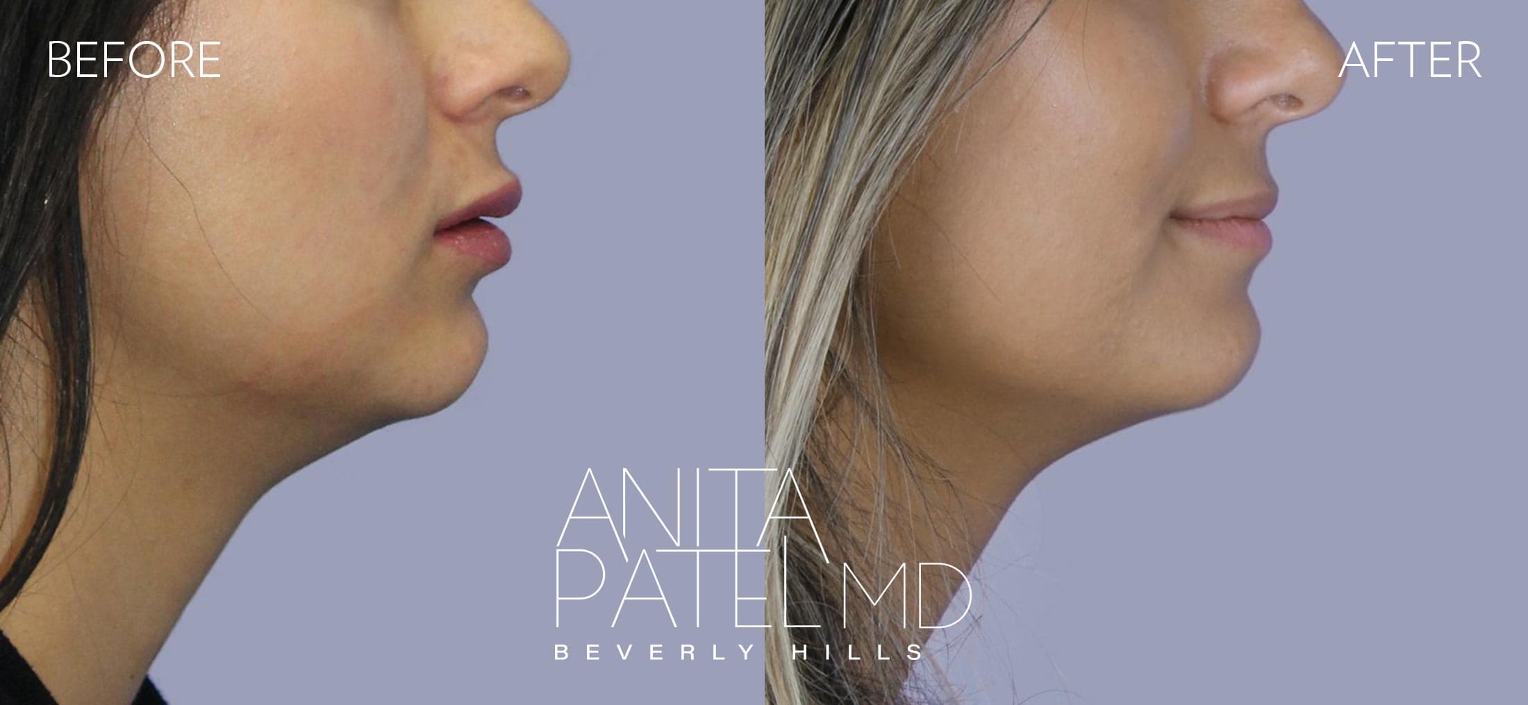 Kybella before and after — Patient 1, photo 2 of 2 — Dr. Anita Patel, MD, FACS, Beverly Hills