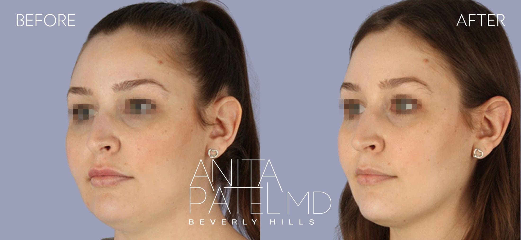 Kybella before and after — Patient 2, photo 1 of 2 — Dr. Anita Patel, MD, FACS, Beverly Hills