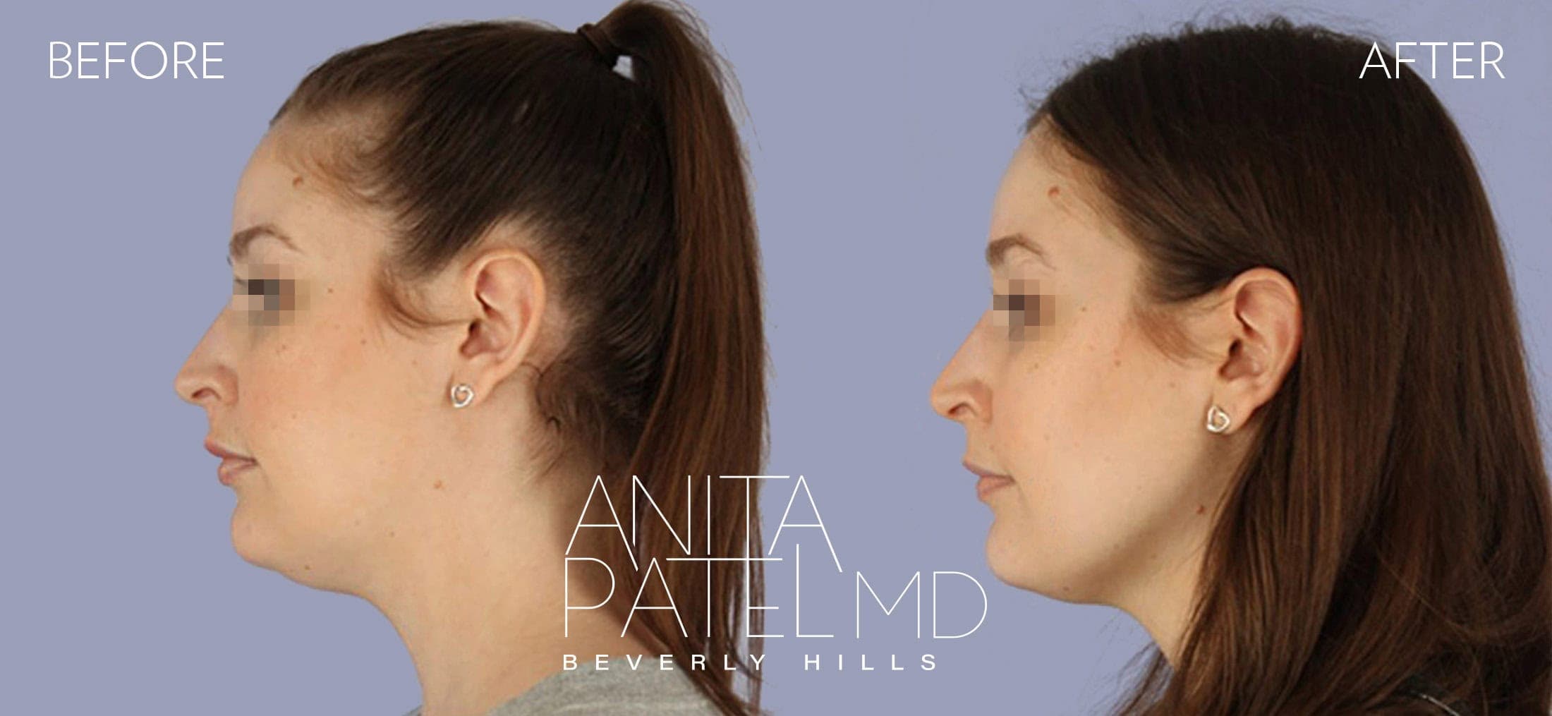 Kybella before and after — Patient 2, photo 2 of 2 — Dr. Anita Patel, MD, FACS, Beverly Hills