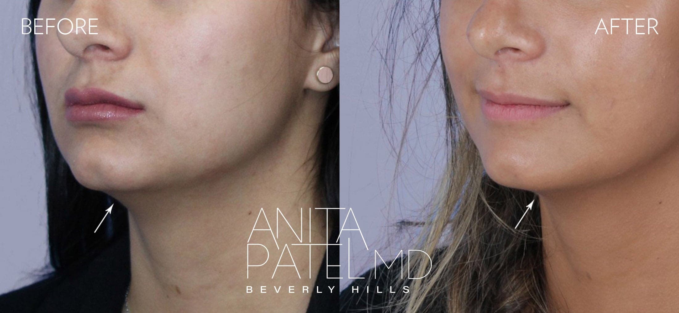 Kybella before and after — Dr. Anita Patel, Beverly Hills
