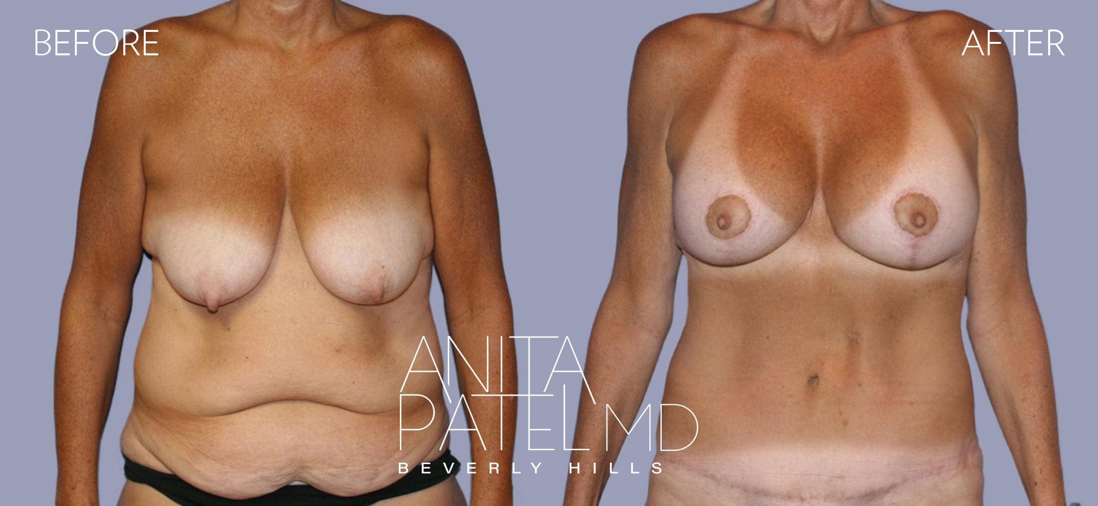 Breast Lift before and after — Patient 13, photo 1 of 3 — Dr. Anita Patel, MD, FACS, Beverly Hills