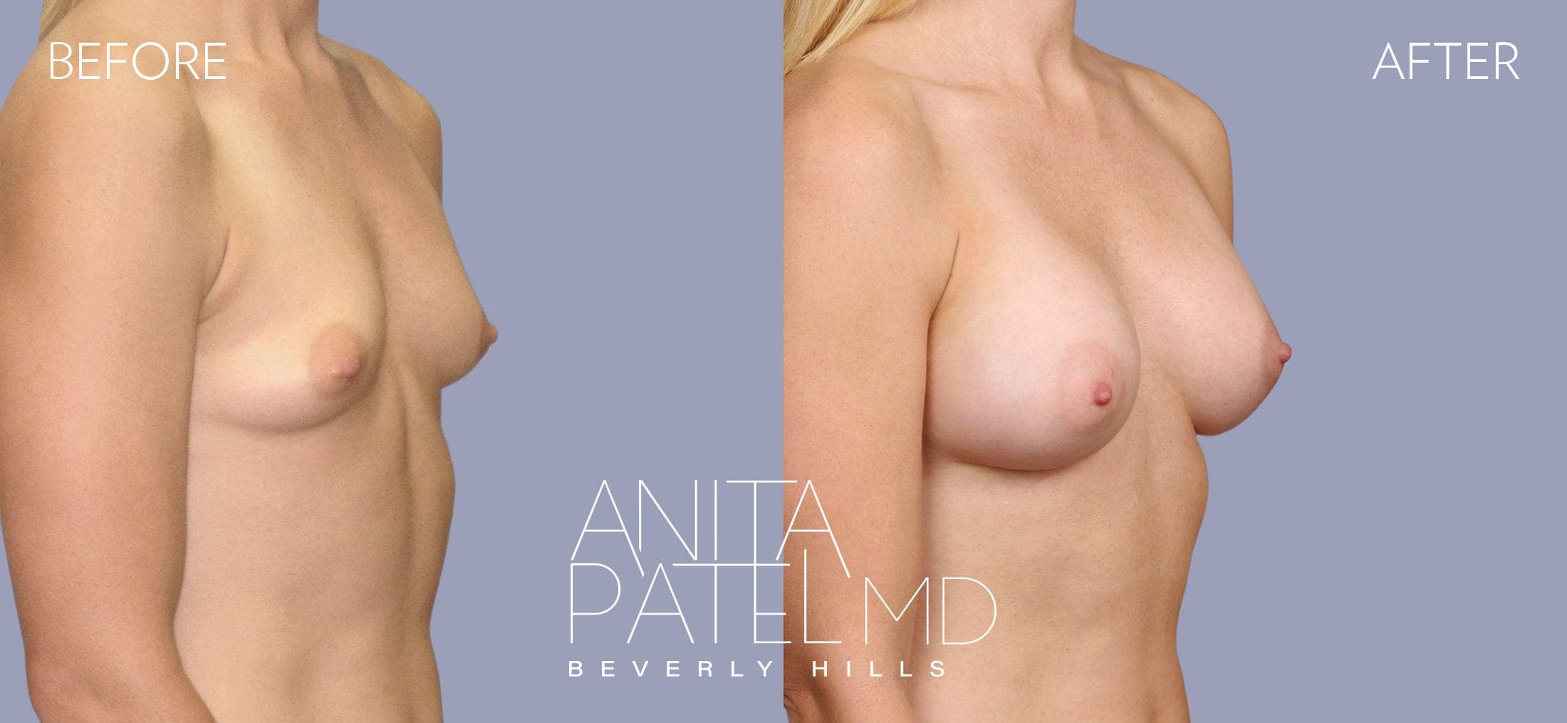 Breast Augmentation before and after — Patient 22, photo 1 of 4 — Dr. Anita Patel, MD, FACS, Beverly Hills
