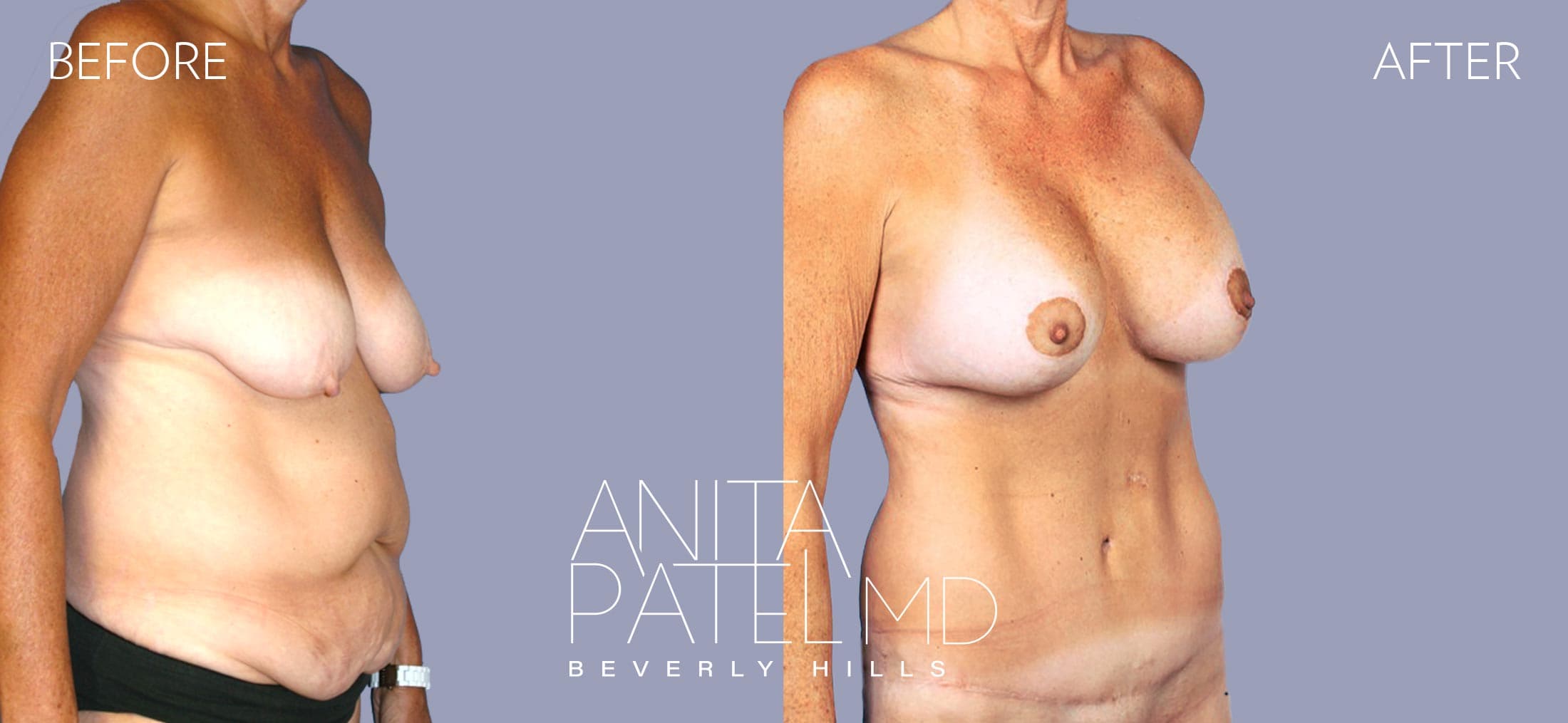 Breast Lift before and after — Patient 13, photo 3 of 3 — Dr. Anita Patel, MD, FACS, Beverly Hills