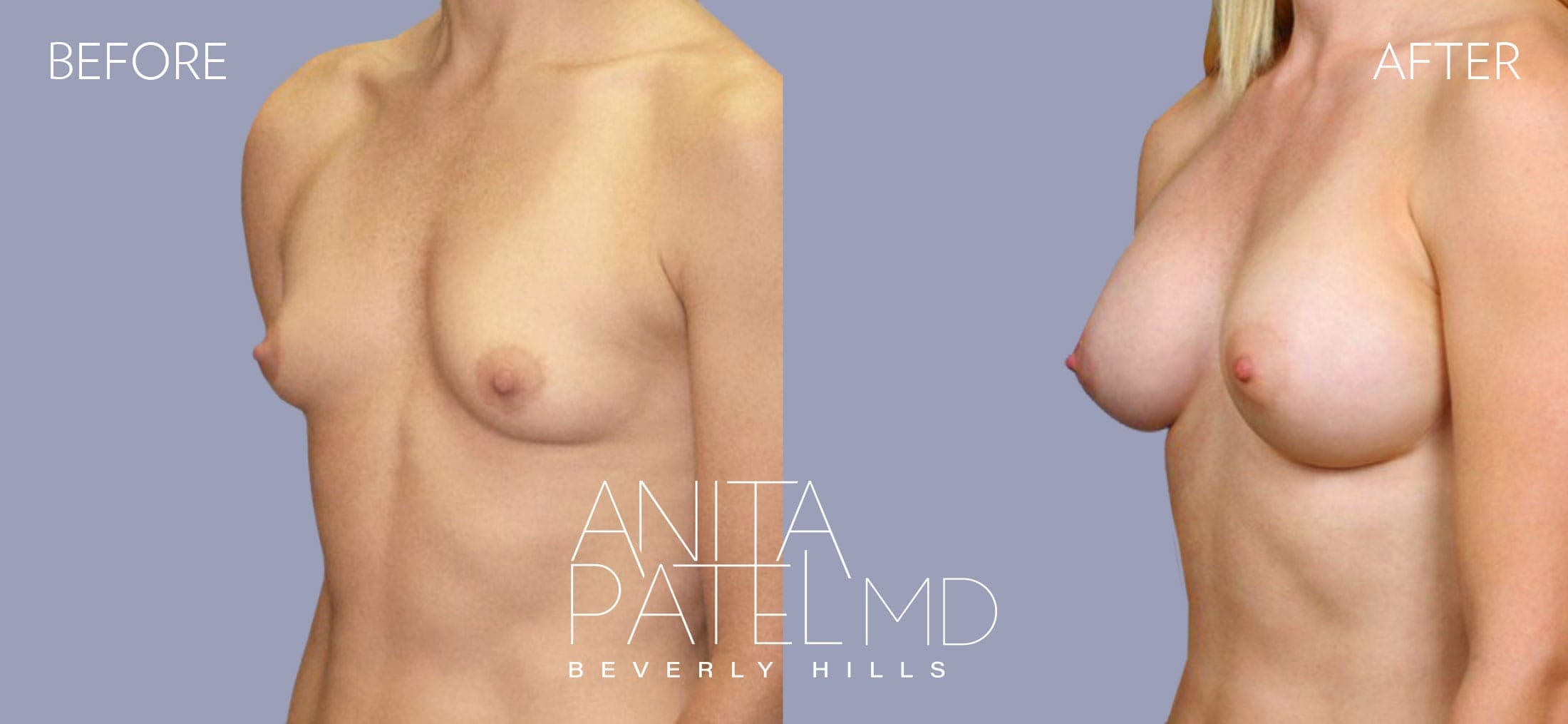 Breast Augmentation before and after — Patient 22, photo 3 of 4 — Dr. Anita Patel, MD, FACS, Beverly Hills