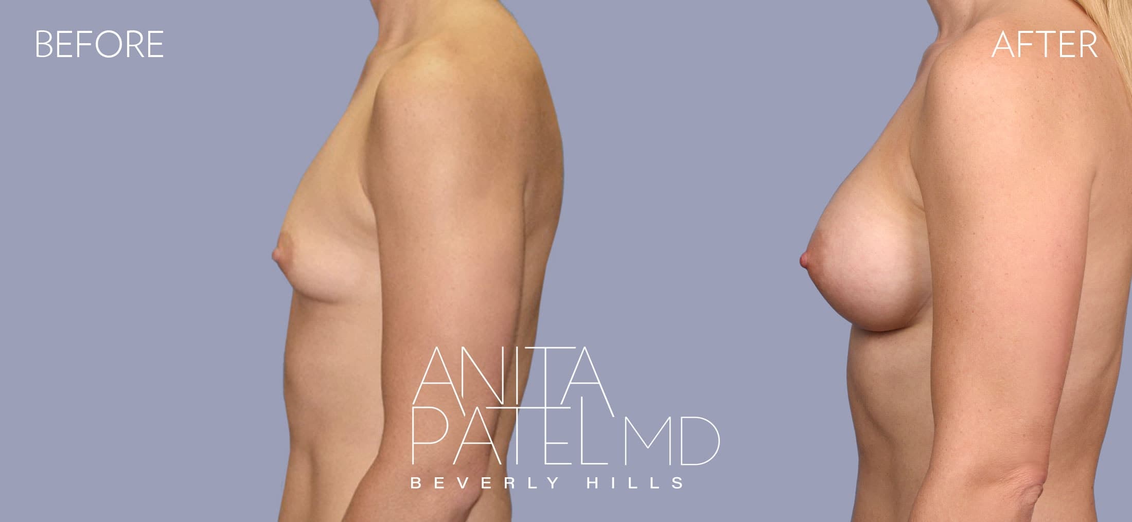 Breast Augmentation before and after — Patient 22, photo 4 of 4 — Dr. Anita Patel, MD, FACS, Beverly Hills