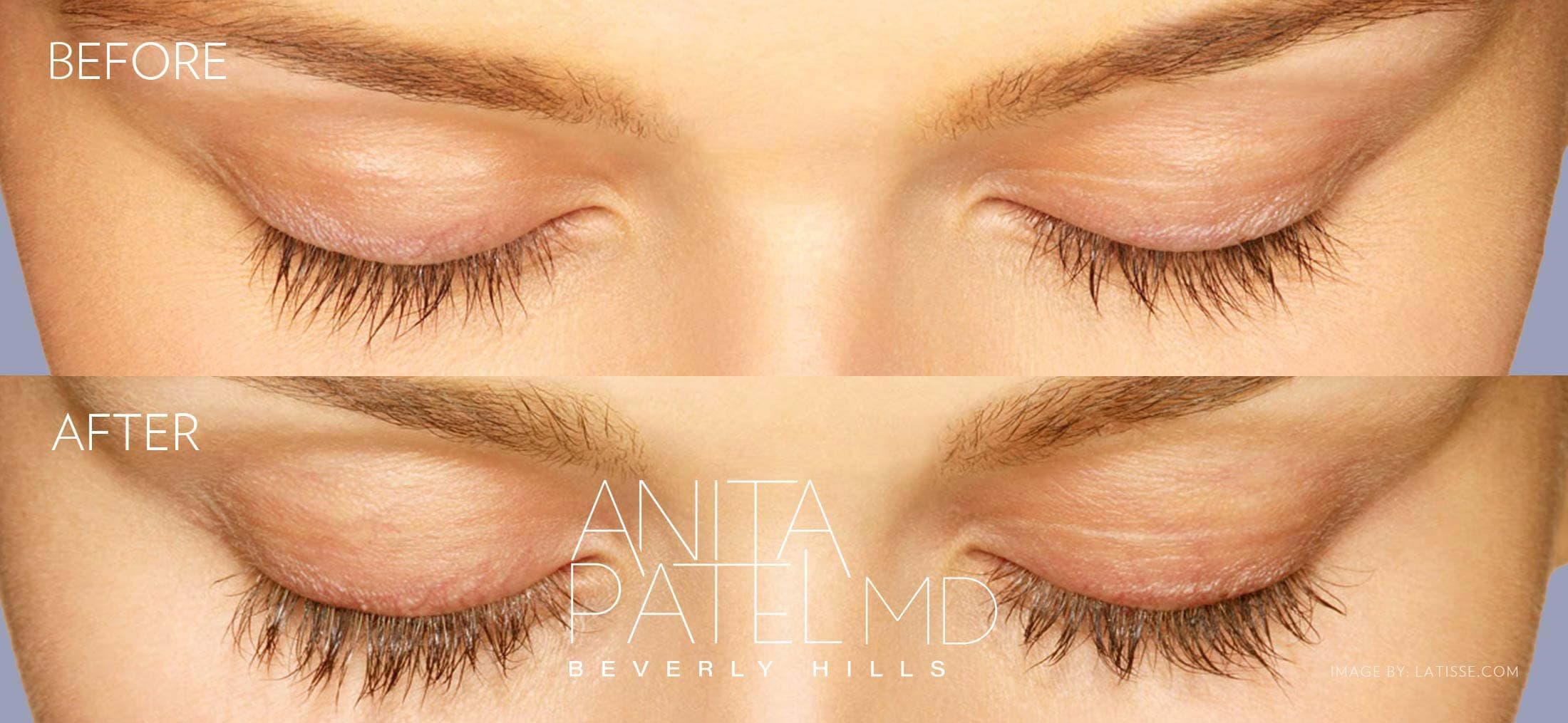 Eyelash Extensions before and after — Dr. Anita Patel, Beverly Hills