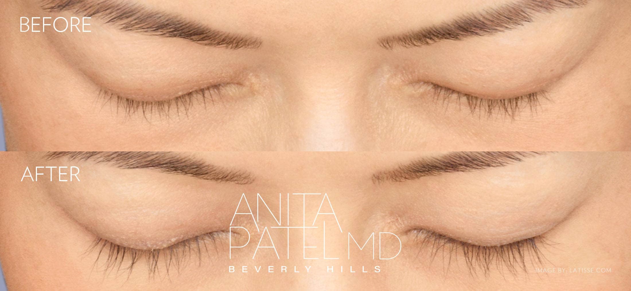Eyelash Extensions before and after — Patient 2 — Dr. Anita Patel, MD, FACS, Beverly Hills