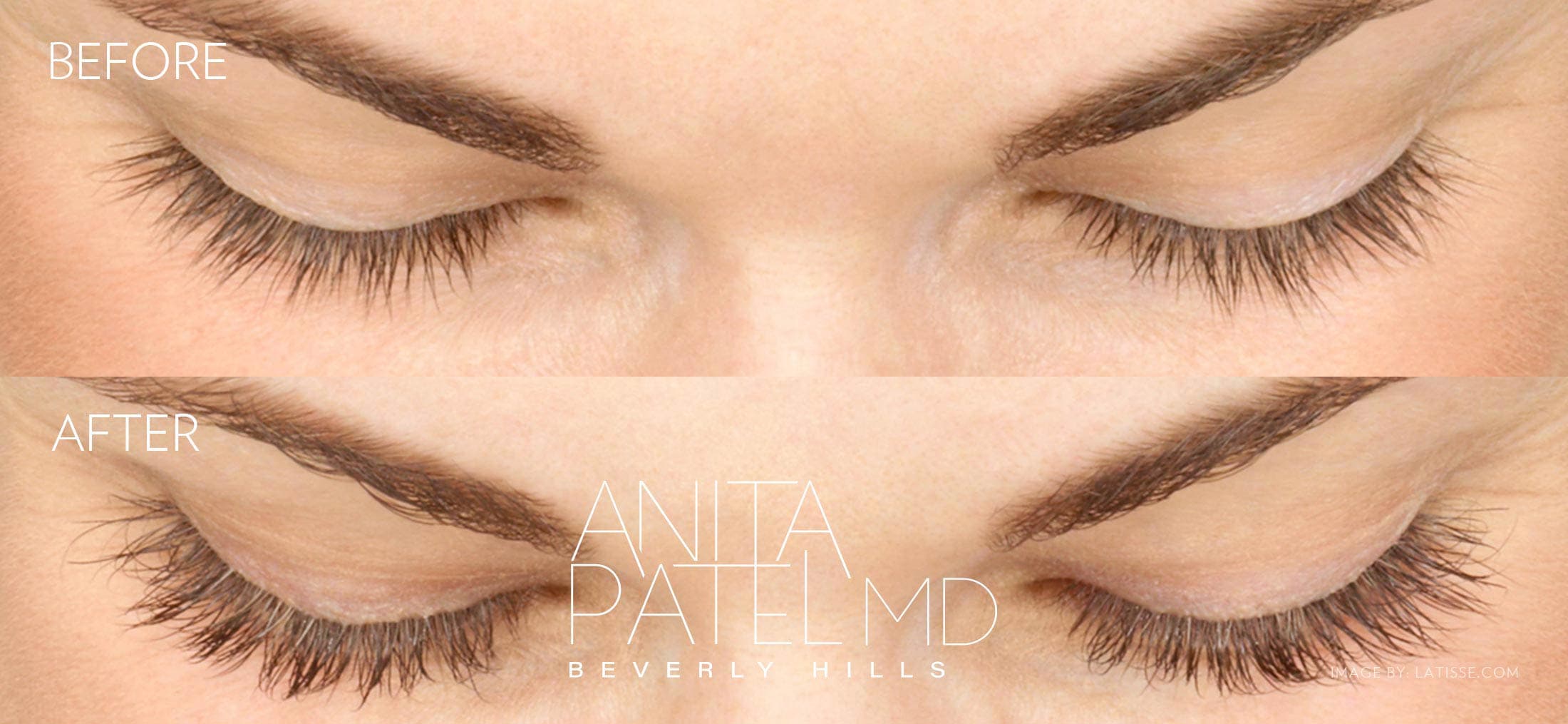 Eyelash Extensions before and after — Patient 3 — Dr. Anita Patel, MD, FACS, Beverly Hills
