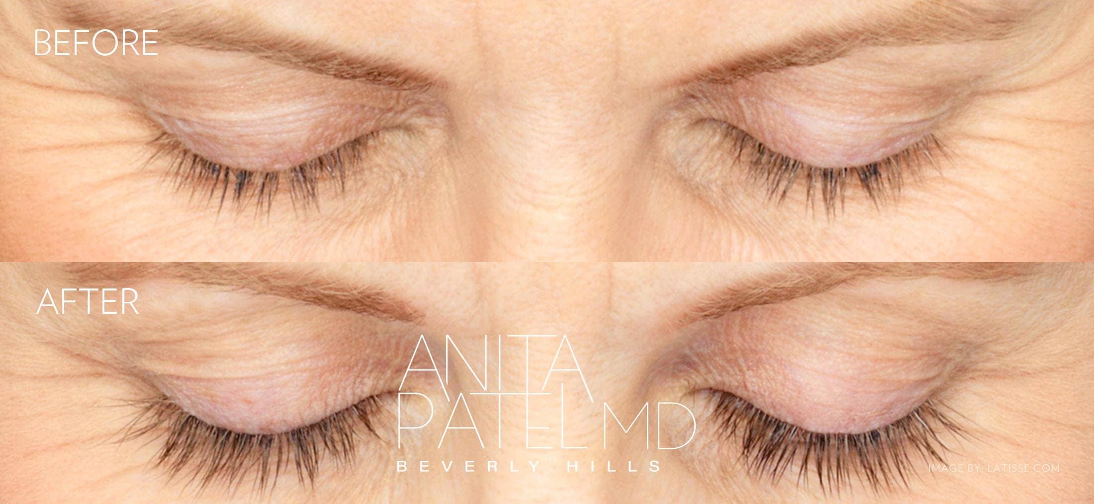 Eyelash Extensions before and after — Patient 4 — Dr. Anita Patel, MD, FACS, Beverly Hills