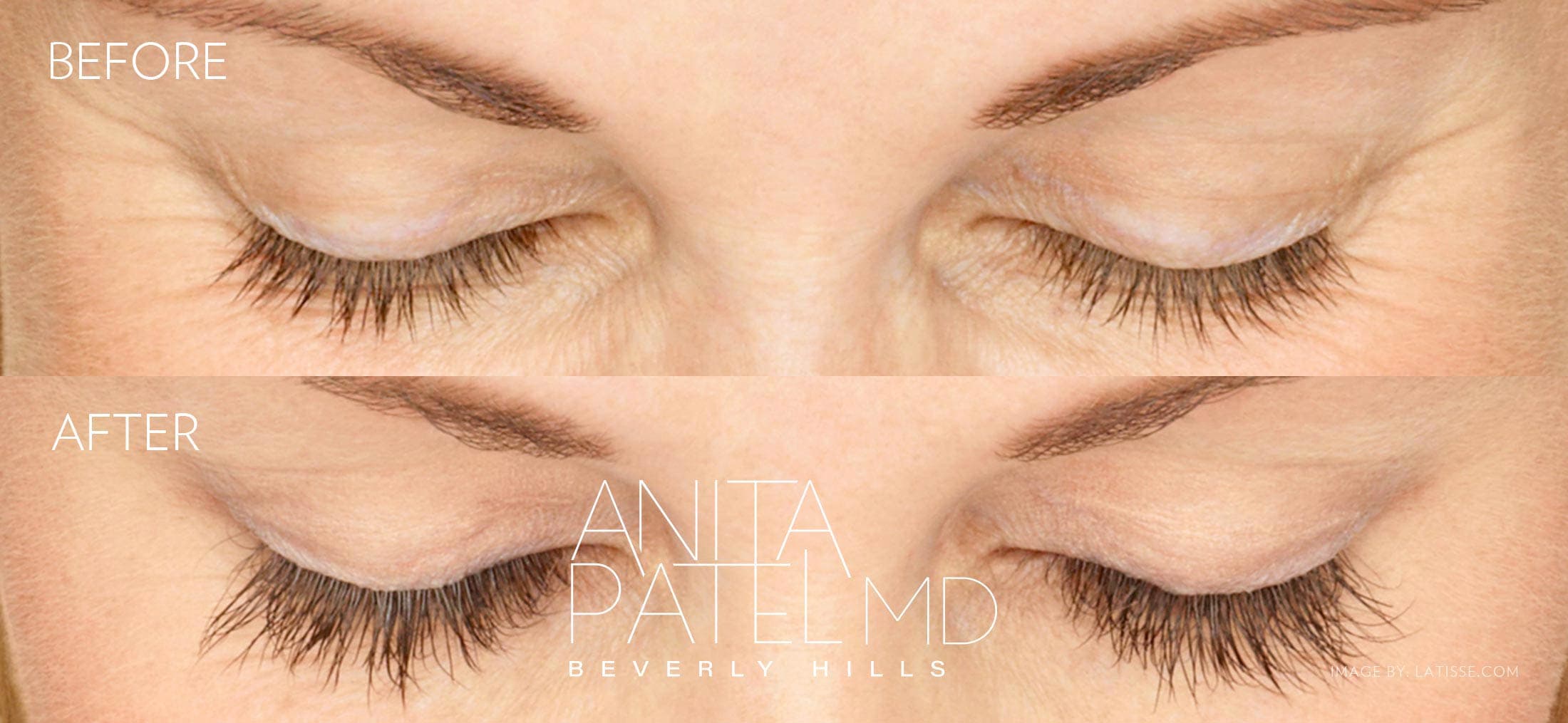 Eyelash Extensions before and after — Patient 5 — Dr. Anita Patel, MD, FACS, Beverly Hills