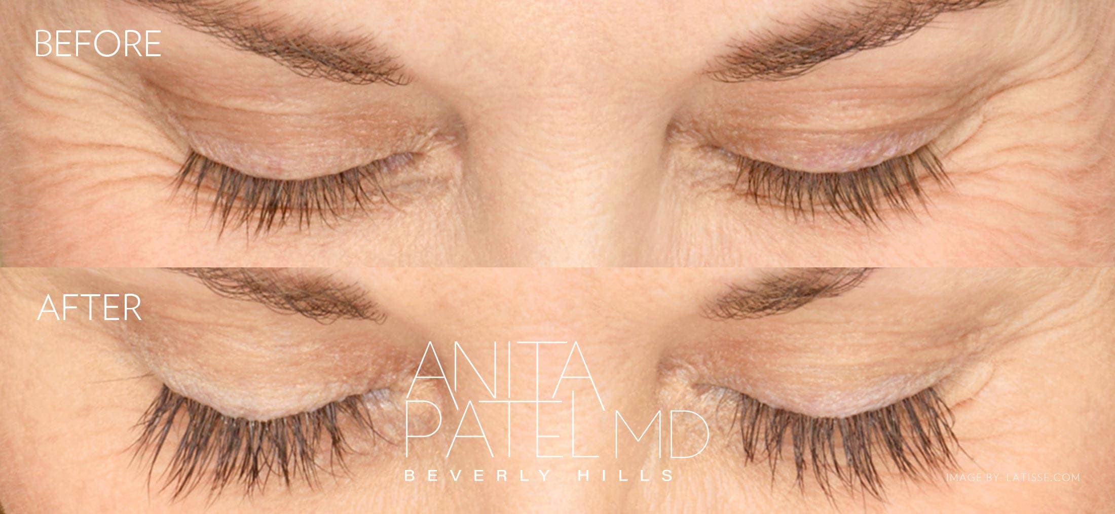 Eyelash Extensions before and after — Patient 6 — Dr. Anita Patel, MD, FACS, Beverly Hills