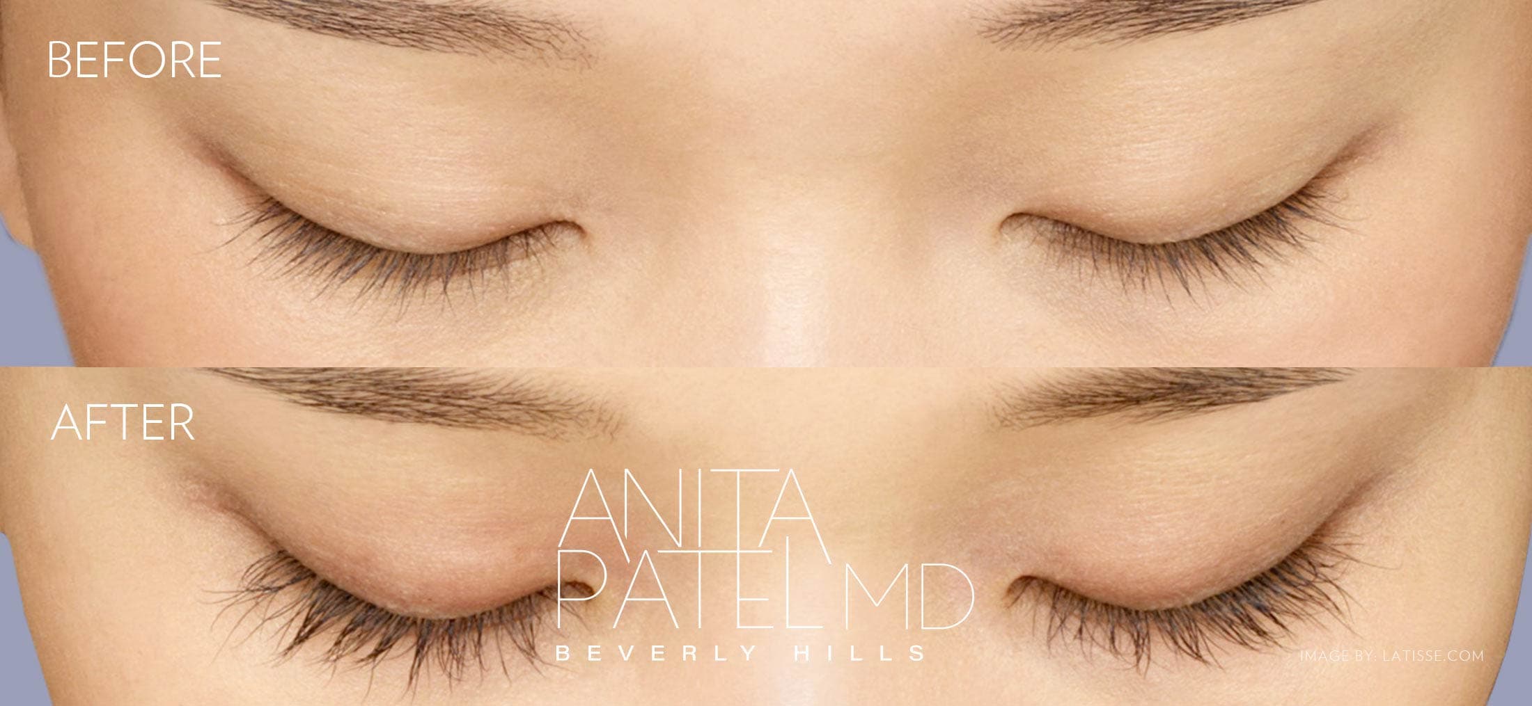 Eyelash Extensions before and after — Patient 7 — Dr. Anita Patel, MD, FACS, Beverly Hills