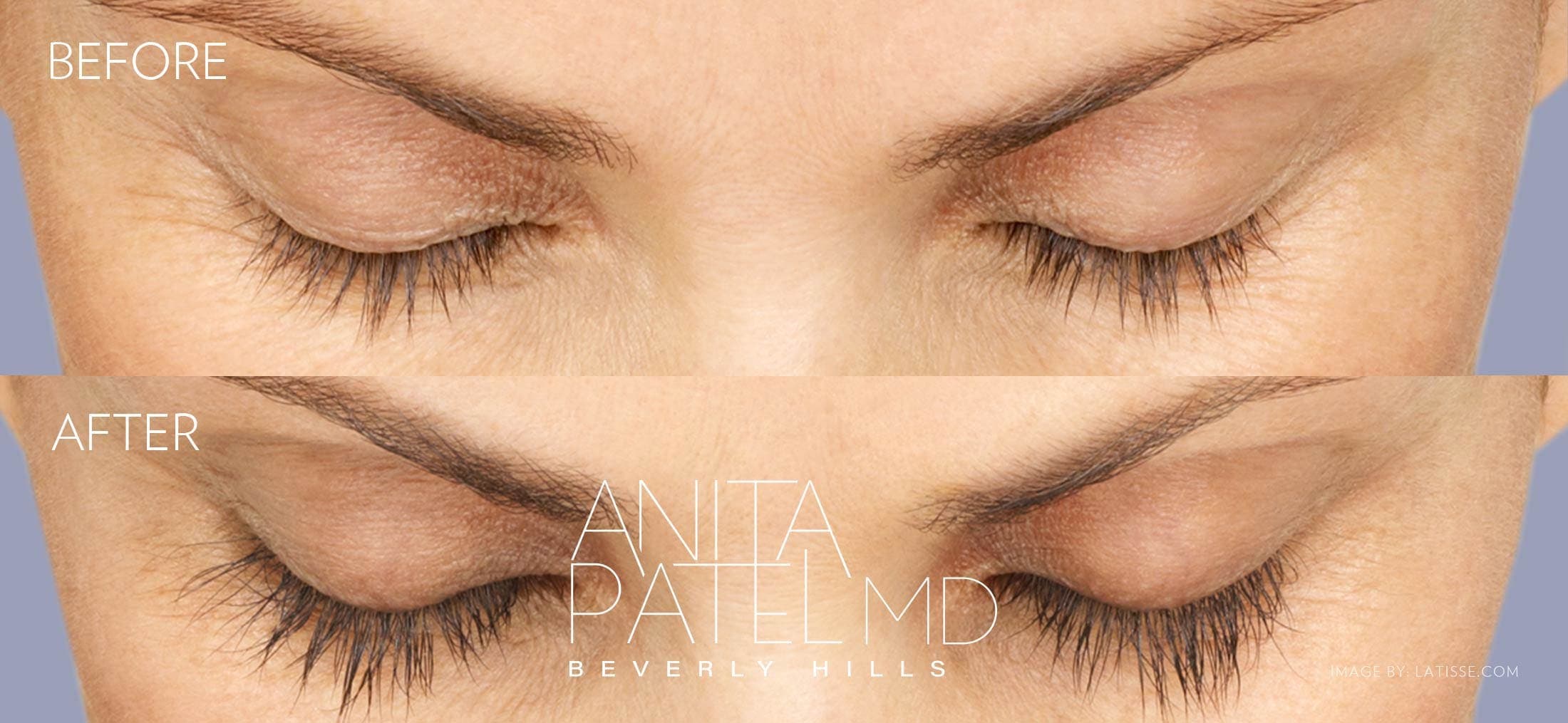 Eyelash Extensions before and after — Patient 8 — Dr. Anita Patel, MD, FACS, Beverly Hills