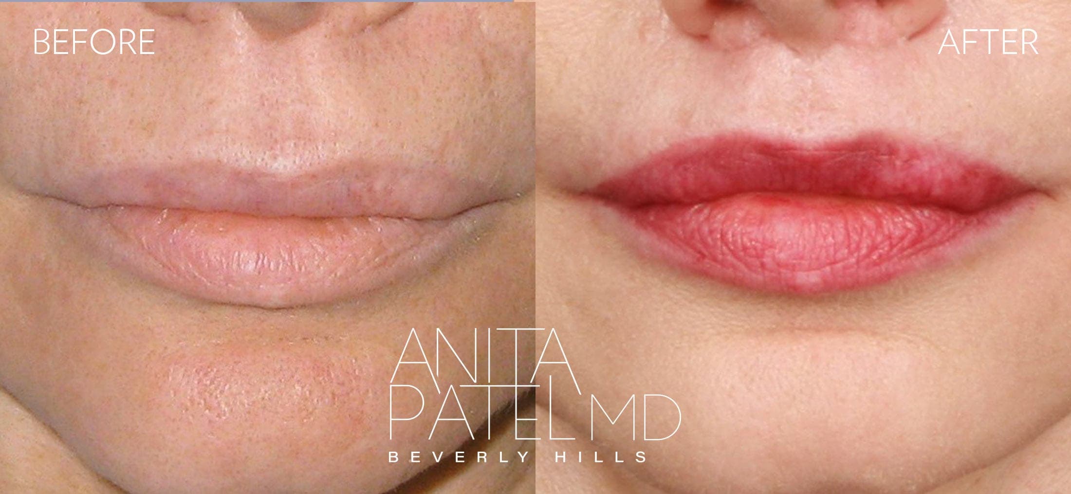 Lip Lift before and after — Dr. Anita Patel, Beverly Hills