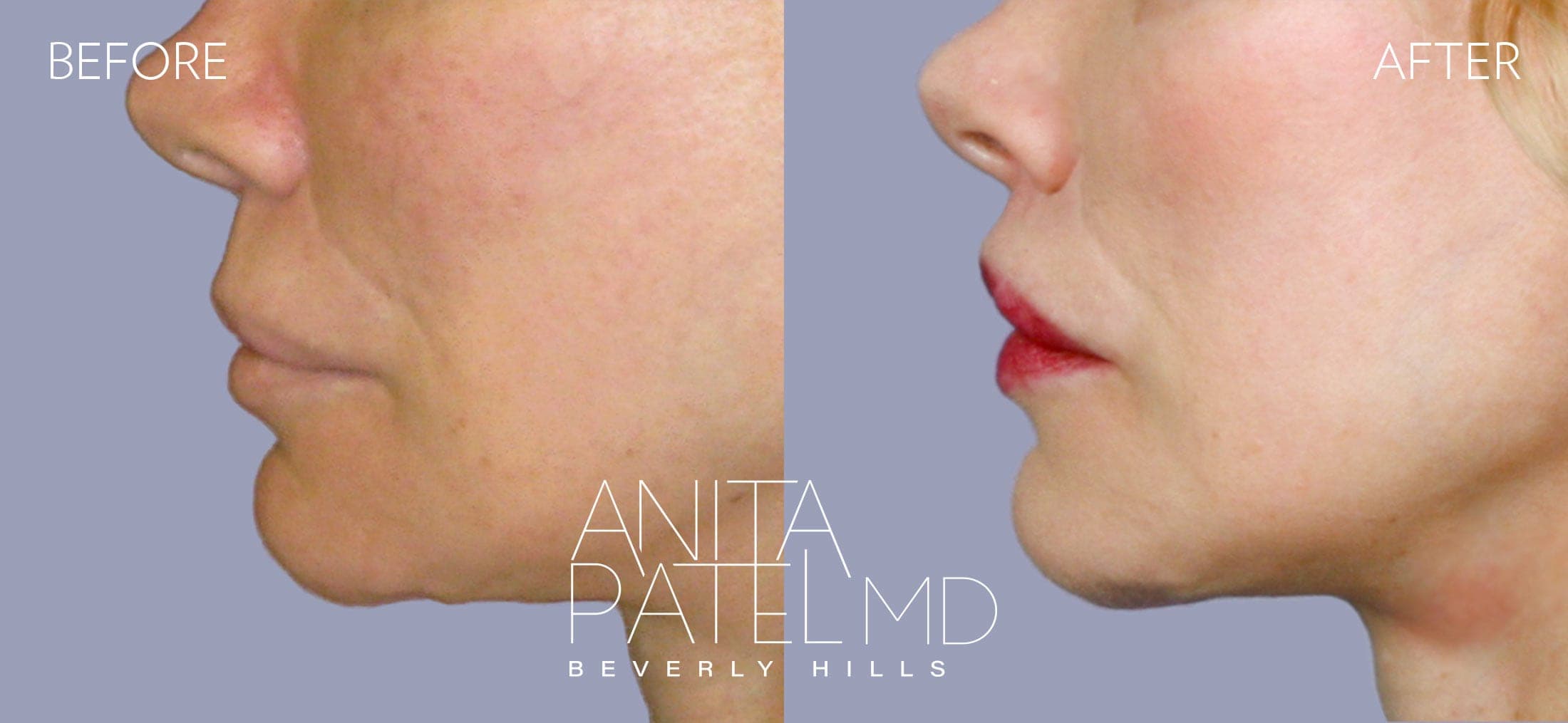 Lip Lift before and after — Patient 1, photo 2 of 2 — Dr. Anita Patel, MD, FACS, Beverly Hills