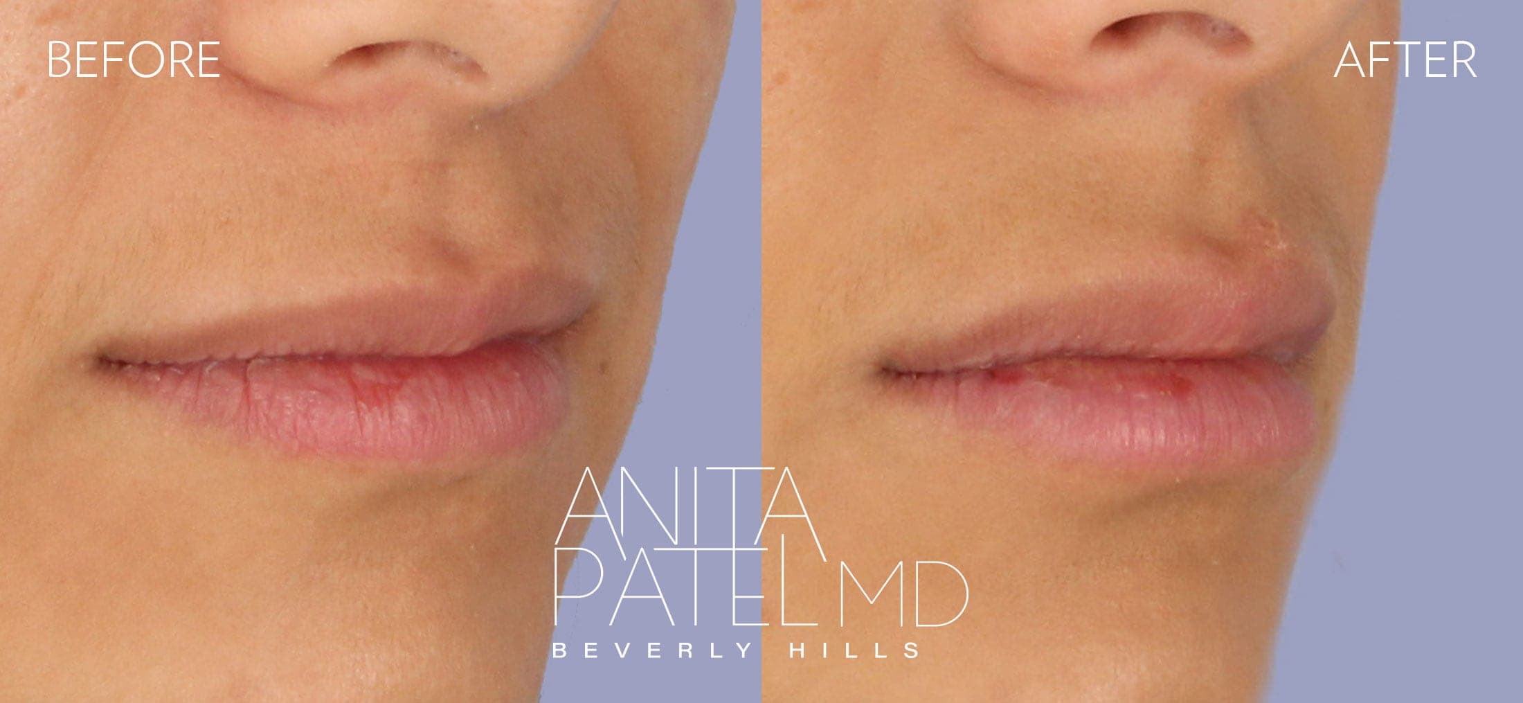 Neurotoxin before and after — Patient 1, photo 2 of 3 — Dr. Anita Patel, MD, FACS, Beverly Hills