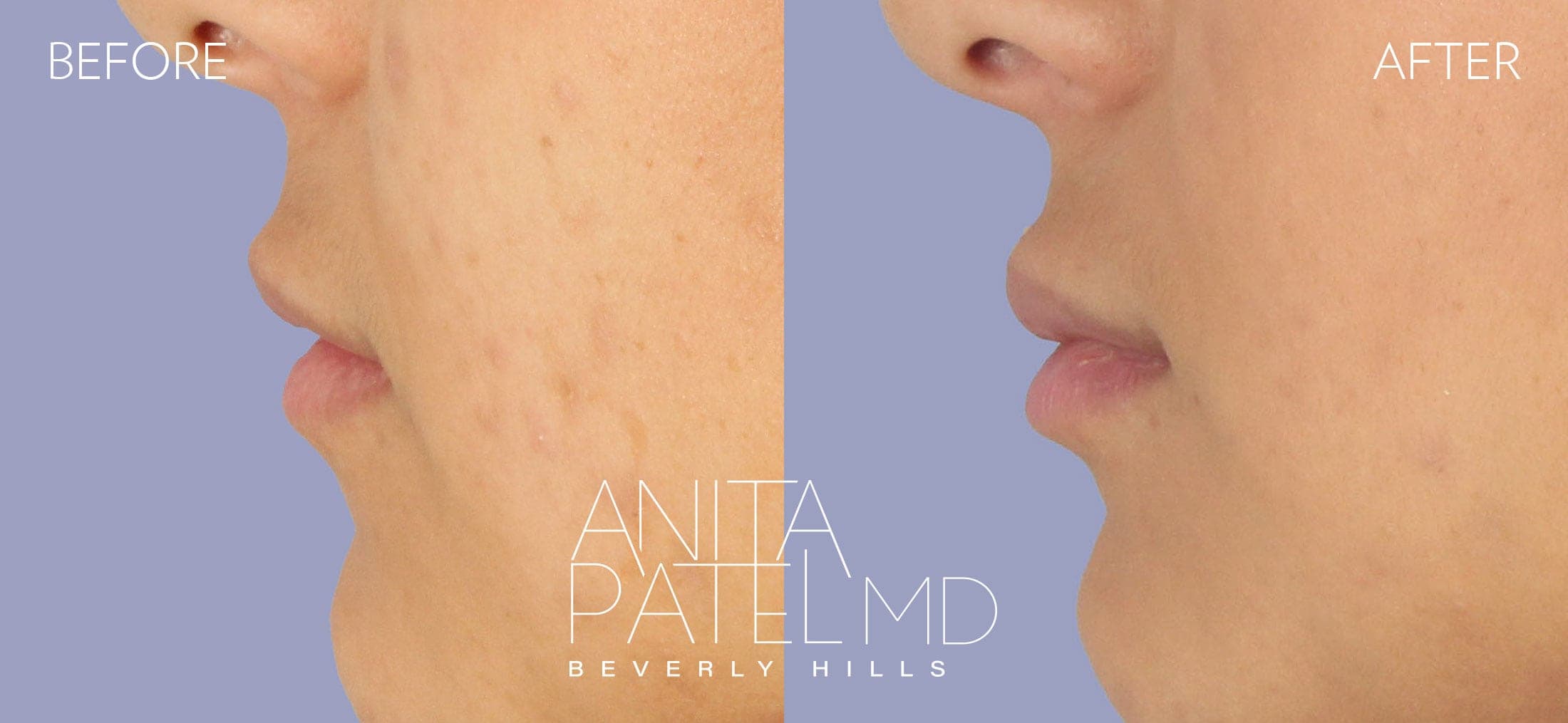 Neurotoxin before and after — Patient 1, photo 3 of 3 — Dr. Anita Patel, MD, FACS, Beverly Hills